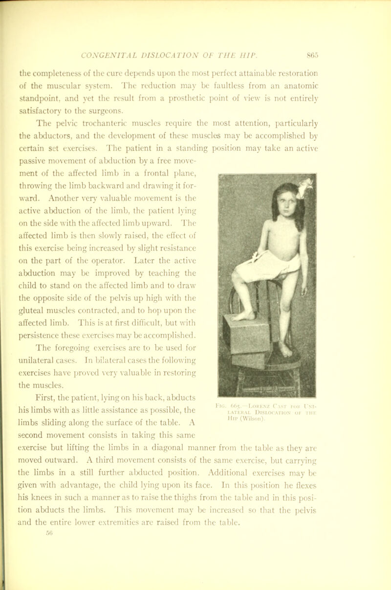 the completeness of the cure depends upon the most perfect attainable restoration of the muscular system. The reduction may be faultless from an anatomic standpoint, and yet the result from a prosthetic point of view is not entirely satisfactory to the surgeons. The pelvic trochanteric muscles require the most attention, particularly the abductors, and the development of these muscles may be accomplished by certain set exercises. The patient in a standing position may take an active passive movement of abduction by a free move- ment of the affected limb in a frontal plane, throwing the limb backward and drawing it for- ward. Another very valuable movement is the active abduction of the limb, the patient lying on the side with the affected limb upward. The affected limb is then slowly raised, the effect of this exercise being increased by slight resistance on the part of the operator. Later the active abduction may be improved by teaching the child to stand on the affected limb and to draw the opposite side of the pelvis up high with the gluteal muscles contracted, and to hop upon the affected limb. This is at first difficult, but with persistence these exercises may be accomplished. The foregoing exercises are to be used for unilateral cases. In bilateral cases the following exercises have proved very valuable in restoring the muscles. First, the patient, lying on his back, abducts his limbs with as little assistance as possible, the lateral Dislocation3 of m limbs sliding along the surface of the table. A second movement consists in taking this same exercise but lifting the limbs in a diagonal manner from the table as they are moved outward. A third movement consists of the same exercise, but carrying the limbs in a still further abducted position. Additional exercises may be given with advantage, the child lying upon its face. In this position he flexes his knees in such a manner as to raise the thighs from the table and in this posi- tion abducts the limbs. This movement may be increased so that the pelvis and the entire lower extremities are raised from the table. 5G