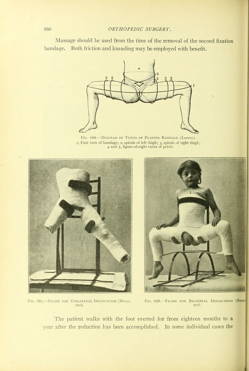 Massage should be used from the time of the removal of the second fixation bandage. Both friction and kneading may be employed with benefit. Fig. 666.—Diagram or Turns of Plaster Bandage (Lorenz). i, First turn of bandage; 2, spirals of left thigh; 3, spirals of right thigh; 4 and 5, figure-of-eight turns of pelvis. Fig. 667.—Frame for Unilateral Dislocation (Heuss- ner). Fig. 668.—Frame for Bilateral Dislocation (Heuss ner). The patient walks with the foot everted for from eighteen months to a year after the reduction has been accomplished. In some individual cases the