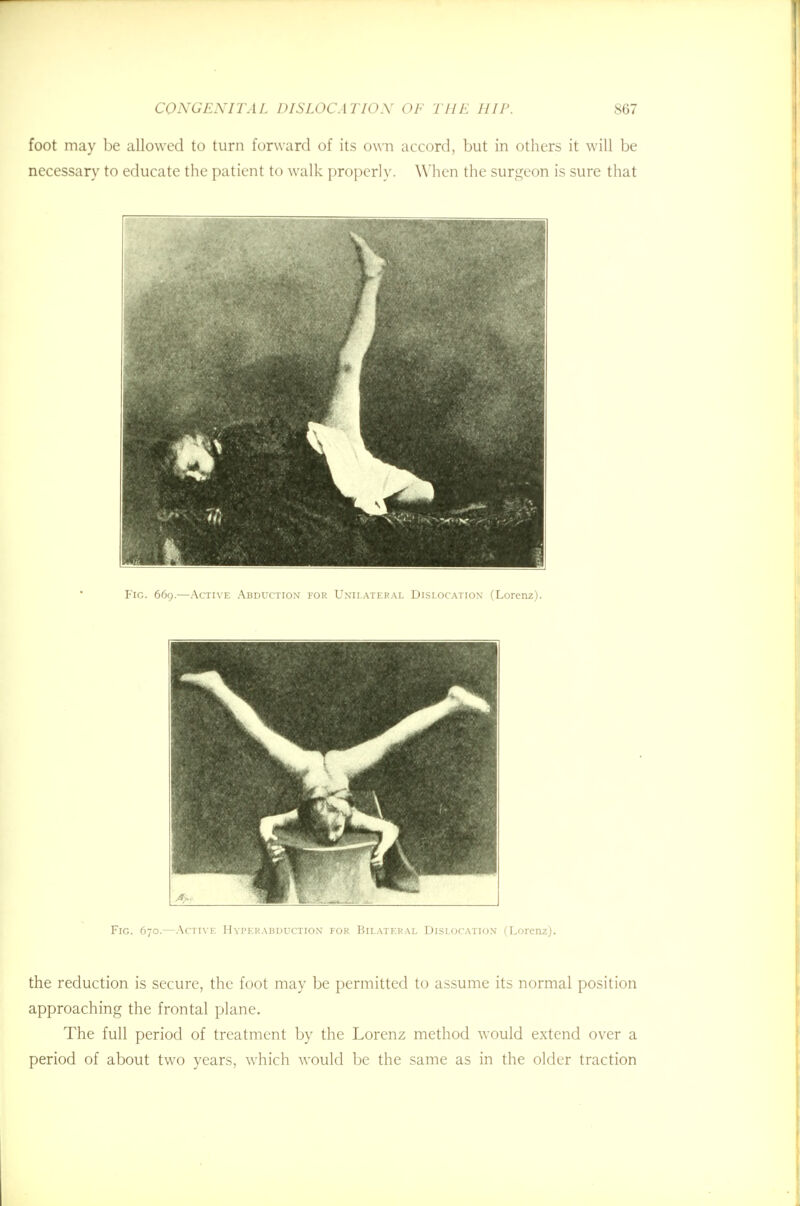 foot may be allowed to turn forward of its own accord, but in others it will be necessary to educate the patient to walk properly. When the surgeon is sure that Fig. 669.—Active Abduction for Unilateral Dislocation (Lorenz). Fig. 670.—Active Hyperabductton for Bilateral Dislocation (Lorenz). the reduction is secure, the foot may be permitted to assume its normal position approaching the frontal plane. The full period of treatment by the Lorenz method would extend over a period of about two years, which would be the same as in the older traction