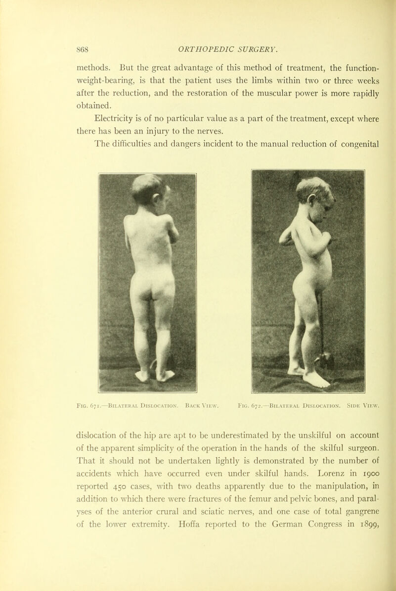 methods. But the great advantage of this method of treatment, the function- weight-bearing, is that the patient uses the limbs within two or three weeks after the reduction, and the restoration of the muscular power is more rapidly obtained. Electricity is of no particular value as a part of the treatment, except where there has been an injury to the nerves. The difficulties and dangers incident to the manual reduction of congenital Fig. 671.—Bilateral Dislocation. Back View. Fig. 672.—Bilateral Dislocation. Side View. dislocation of the hip are apt to be underestimated by the unskilful on account of the apparent simplicity of the operation in the hands of the skilful surgeon. That it should not be undertaken lightly is demonstrated by the number of accidents which have occurred even under skilful hands. Lorenz in 1900 reported 450 cases, with two deaths apparently due to the manipulation, in addition to which there were fractures of the femur and pelvic bones, and paral- yses of the anterior crural and sciatic nerves, and one case of total gangrene of the lower extremity. Hoffa reported to the German Congress in 1899,