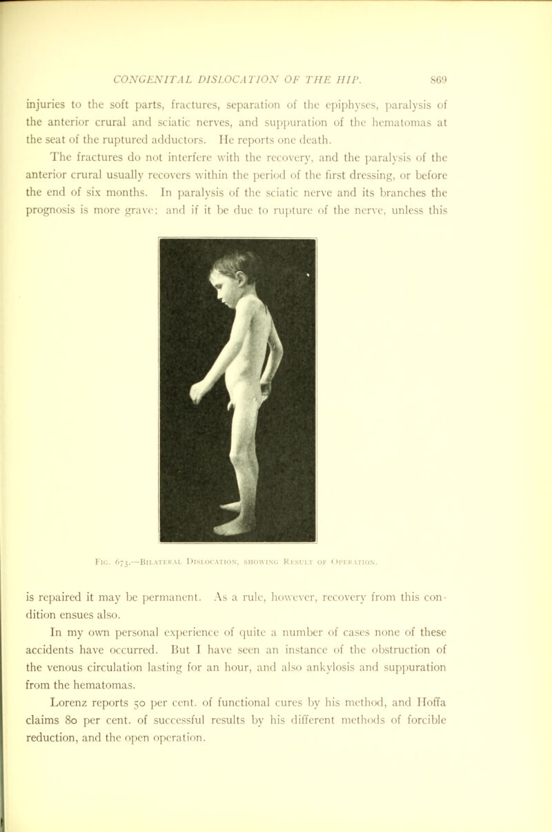 injuries to the soft parts, fractures, separation of the epiphyses, paralysis of the anterior crural and sciatic nerves, and suppuration of the hematomas at the seat of the ruptured adductors. He reports one death. The fractures do not interfere with the recovery, and the paralysis of the anterior crural usually recovers within the period of the first dressing, or before the end of six months. In paralysis of the sciatic nerve and its branches the prognosis is more grave; and if it be due to rupture of the nerve, unless this Fig. 673.—Bilateral Dislocation, showing Result of Operation. is repaired it may be permanent. As a rule, however, recovery from this con- dition ensues also. In my own personal experience of quite a number of cases none of these accidents have occurred. But I have seen an instance of the obstruction of the venous circulation lasting for an hour, and also ankylosis and suppuration from the hematomas. Lorenz reports 50 per cent, of functional cures by his method, and Hoffa claims 80 per cent, of successful results by his different methods of forcible reduction, and the open operation.
