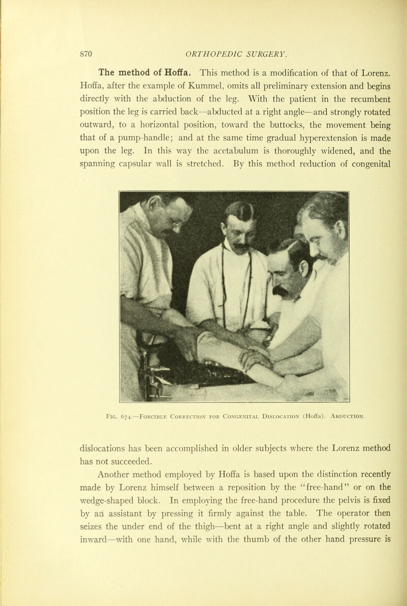 The method of Hoffa. This method is a modification of that of Lorenz. Hoffa, after the example of Kummel, omits all preliminary extension and begins directly with the abduction of the leg. With the patient in the recumbent position the leg is carried back—abducted at a right angle—and strongly rotated outward, to a horizontal position, toward the buttocks, the movement being that of a pump-handle; and at the same time gradual hyperextension is made upon the leg. In this way the acetabulum is thoroughly widened, and the spanning capsular wall is stretched. By this method reduction of congenital Fig. 674.—Forcible Correction for Congenital Dislocation (Hoffa). Abduction. dislocations has been accomplished in older subjects where the Lorenz method has not succeeded. Another method employed by Hoffa is based upon the distinction recently made by Lorenz himself between a reposition by the free-hand or on the wedge-shaped block. In employing the free-hand procedure the pelvis is fixed by an assistant by pressing it firmly against the table. The operator then seizes the under end of the thigh—bent at a right angle and slightly rotated inward—with one hand, while with the thumb of the other hand pressure is