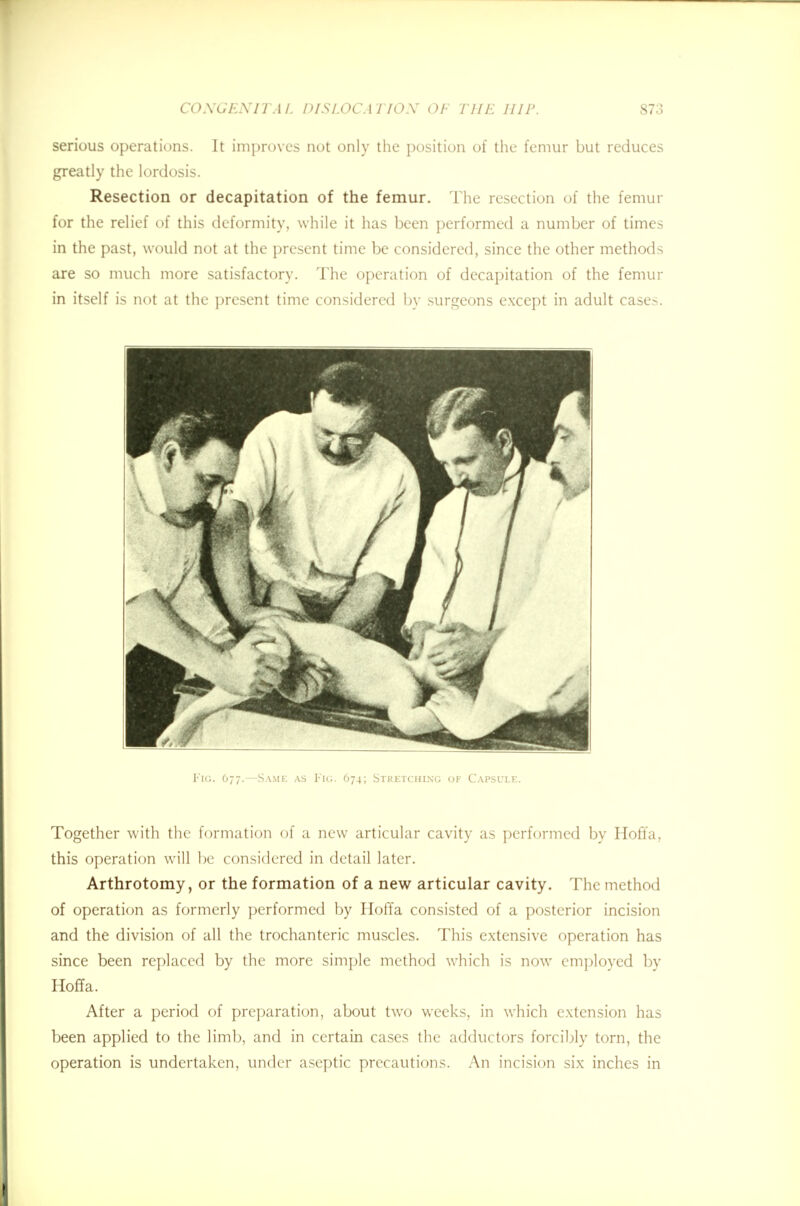 serious operations. It improves not only the position of the femur but reduces greatly the lordosis. Resection or decapitation of the femur. The resection of the femur for the relief of this deformity, while it has been performed a number of times in the past, would not at the present time be considered, since the other methods are so much more satisfactory. The operation of decapitation of the femur in itself is not at the present time considered by surgeons except in adult cases. Fig. 677.—Same as Fig. 674; Stretching of Capsule. Together with the formation of a new articular cavity as performed by Hoffa, this operation will be considered in detail later. Arthrotomy, or the formation of a new articular cavity. The method of operation as formerly performed by Hoffa consisted of a posterior incision and the division of all the trochanteric muscles. This extensive operation has since been replaced by the more simple method which is now employed by Hoffa. After a period of preparation, about two weeks, in which extension has been applied to the limb, and in certain cases the adductors forcibly torn, the operation is undertaken, under aseptic precautions. An incision six inches in