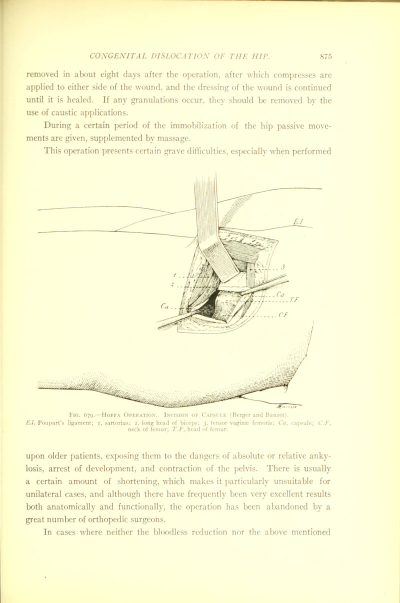 removed in about eight days after the operation, after which compresses are applied to either side of the wound, and the dressing of the wound is continued until it is healed. If any granulations occur, they should be removed by the use of caustic applications. During a certain period of the immobilization of the hip passive move- ments are given, supplemented by massage. This operation presents certain grave difficulties, especially when performed Fig. 679.—Hoffa Operation. Incision of Capsule (Bcrgcr and Banzet). E.l, Poupart's ligament; 1, sartorius; 2, long head of biceps; 3, tensor vagina; femoris; Ca, capsule; C.F, neck of femur; T.F, head of femur. upon older patients, exposing them to the dangers of absolute or relative anky- losis, arrest of development, and contraction of the pelvis. There is usually a certain amount of shortening, which makes it particularly unsuitable for unilateral cases, and although there have frequently been very excellent results both anatomically and functionally, the operation has been abandoned by a great number of orthopedic surgeons. In cases where neither the bloodless reduction nor the above mentioned