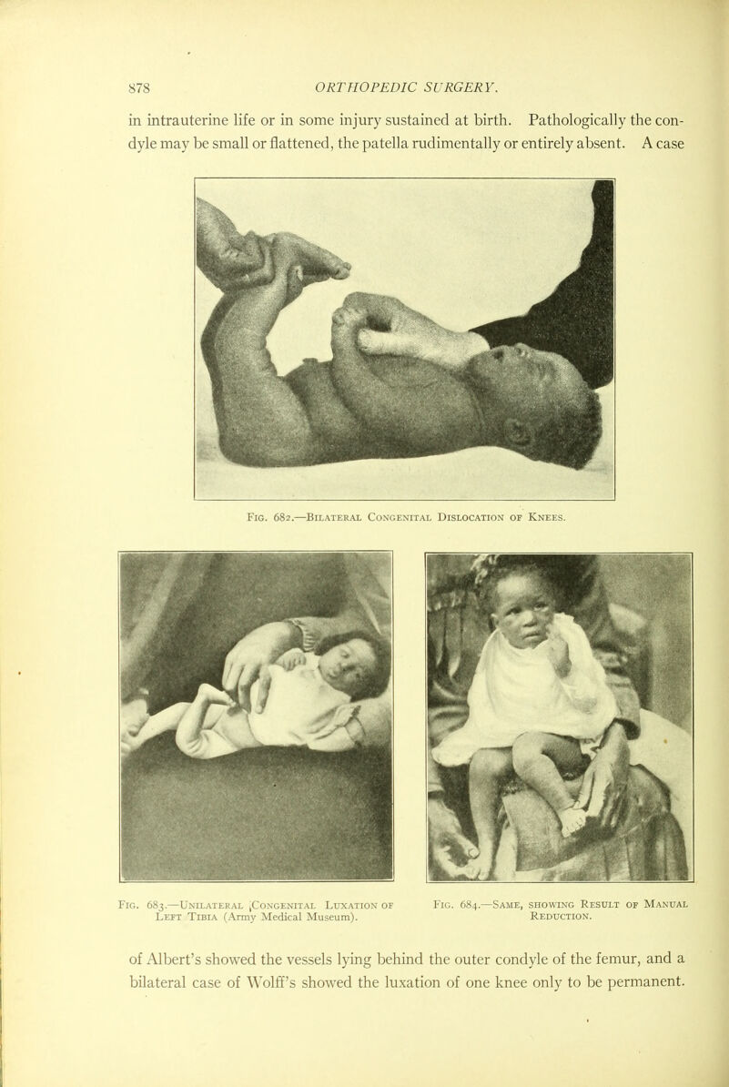 in intrauterine life or in some injury sustained at birth. Pathologically the con- dyle may be small or flattened, the patella rudimentally or entirely absent. A case Fig. 682.—Bilateral Congenital Dislocation of Knees. Fig. 683— Unilateral tCoNGENiTAL Luxation of Fig. 684.—Same, showing Result of Manual Left Tibia (Army Medical Museum). Reduction. of Albert's showed the vessels lying behind the outer condyle of the femur, and a bilateral case of Wolff's showed the luxation of one knee only to be permanent.