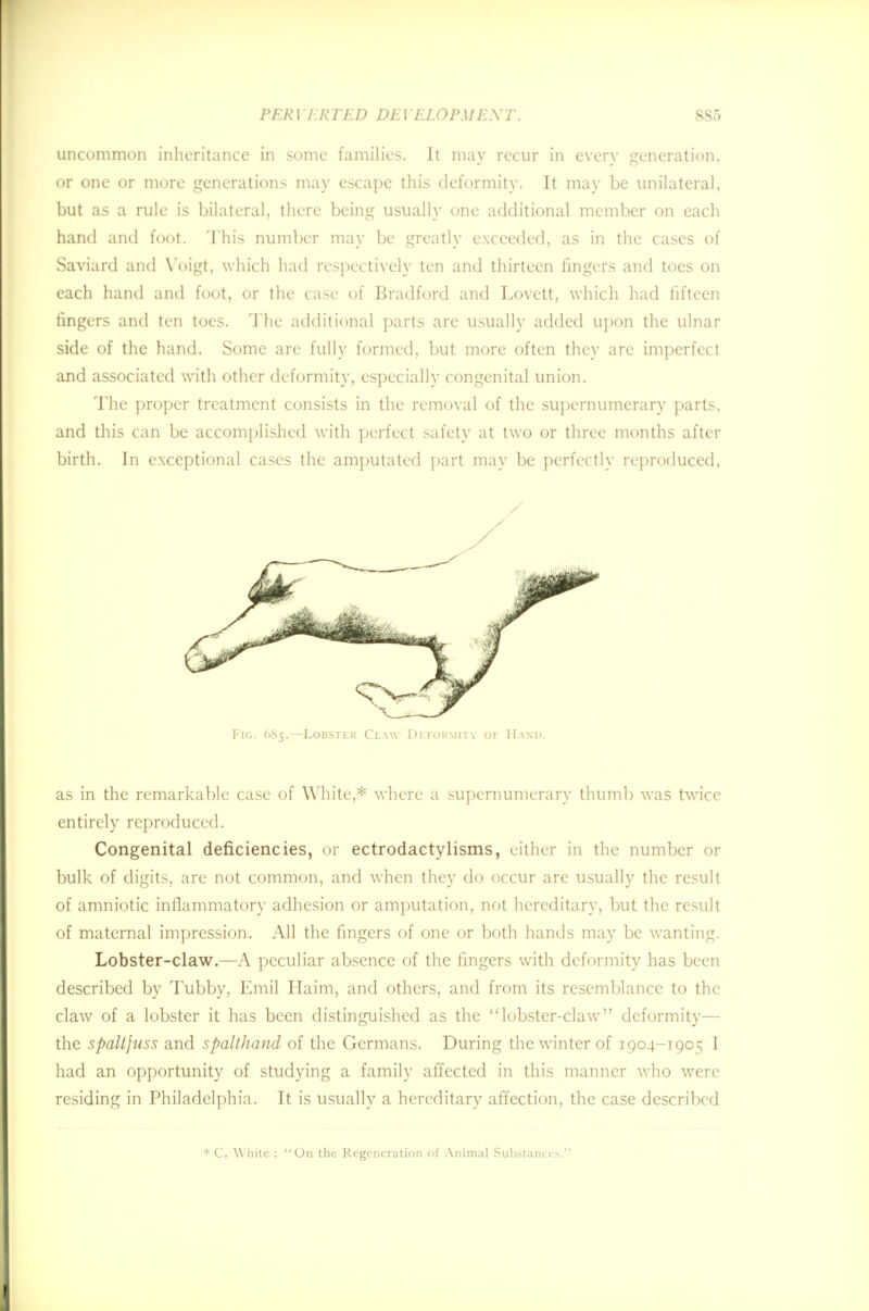 uncommon inheritance in some families. It may recur in every generation, or one or more generations may escape this deformity. It may be unilateral, but as a rule is bilateral, there being usually one additional member on each hand and foot. This number may be greatly exceeded, as in the cases of Saviard and Yoigt, which had respectively ten and thirteen fingers and toes on each hand and foot, or the case of Bradford and Lovett, which had fifteen fingers and ten toes. The additional parts are usually added upon the ulnar side of the hand. Some are fully formed, but more often they arc imperfect and associated with other deformity, especially congenital union. The proper treatment consists in the removal of the supernumerary parts, and this can be accomplished with perfect safety at two or three months after birth. In exceptional cases the amputated part may be perfectly reproduced, as in the remarkable case of White,* where a supernumerary thumb was twice entirely reproduced. Congenital deficiencies, or ectrodactylisms, either in the number or bulk of digits, are not common, and when they do occur are usually the result of amniotic inflammatory adhesion or amputation, not hereditary, but the result of maternal impression. All the fingers of one or both hands may be wanting. Lobster-claw.—A peculiar absence of the fingers with deformity has been described by Tubby, Emil Haim, and others, and from its resemblance to the claw of a lobster it has been distinguished as the lobster-claw deformity— the spaltjuss and spalthand of the Germans. During the winter of 1904-1905 I had an opportunity of studying a family affected in this manner who were residing in Philadelphia. It is usually a hereditary affection, the case described Fig. 685.—Lobster Claw Deformity of Hand. * C. White : On the Regeneration of Animal Substances.