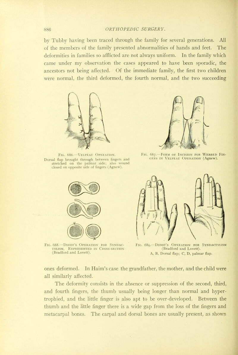 by Tubby having been traced through the family for several generations. All of the members of the family presented abnormalities of hands and feet. The deformities in families so afflicted are not always uniform. In the family which came under my observation the cases appeared to have been sporadic, the ancestors not being affected. Of the immediate family, the first two children were normal, the third deformed, the fourth normal, and the two succeeding Fig. 688.—Didot's Operation for Syndac- tylism, Represented in Cross-section (Bradford and Lovett). Fig. 689.—Didot's Operation for Syndactylism (Bradford and Lovett). A, B, Dorsal flap; C, D, palmar flap. ones deformed. In Haim's case the grandfather, the mother, and the child were all similarlv affected. The deformity consists in the absence or suppression of the second, third, and fourth fingers, the thumb usually being longer than normal and hyper- trophied, and the little finger is also apt to be over-developed. Between the thumb and the little finger there is a wide gap from the loss of the fingers and metacarpal bones. The carpal and dorsal bones are usually present, as shown