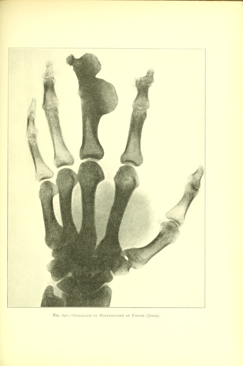 Fig. 696.—Skiagraph of Hypertrophy of Finger (Jones).