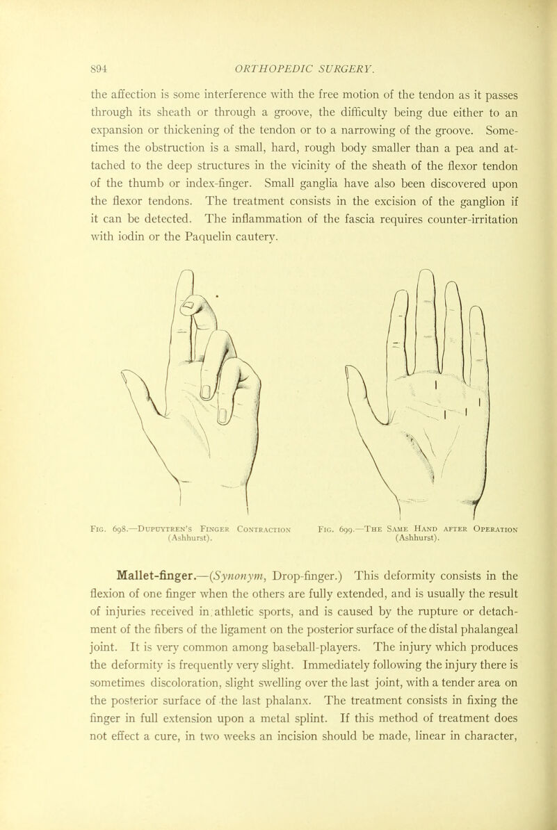 the affection is some interference with the free motion of the tendon as it passes through its sheath or through a groove, the difficulty being due either to an expansion or thickening of the tendon or to a narrowing of the groove. Some- times the obstruction is a small, hard, rough body smaller than a pea and at- tached to the deep structures in the vicinity of the sheath of the flexor tendon of the thumb or index-finger. Small ganglia have also been discovered upon the flexor tendons. The treatment consists in the excision of the ganglion if it can be detected. The inflammation of the fascia requires counter-irritation with iodin or the Paquelin cautery. Fig. 698.—Dupuytren's Finger Contraction Fig. 699.—The Same Hand after Operation (Ashhurst). (Ashhurst). Mallet-finger.—{Synonym, Drop-finger.) This deformity consists in the flexion of one finger when the others are fully extended, and is usually the result of injuries received in. athletic sports, and is caused by the rupture or detach- ment of the fibers of the ligament on the posterior surface of the distal phalangeal joint. It is very common among baseball-players. The injury which produces the deformity is frequently very slight. Immediately following the injury there is sometimes discoloration, slight swelling over the last joint, with a tender area on the posterior surface of the last phalanx. The treatment consists in fixing the finger in full extension upon a metal splint. If this method of treatment does not effect a cure, in two weeks an incision should be made, linear in character,