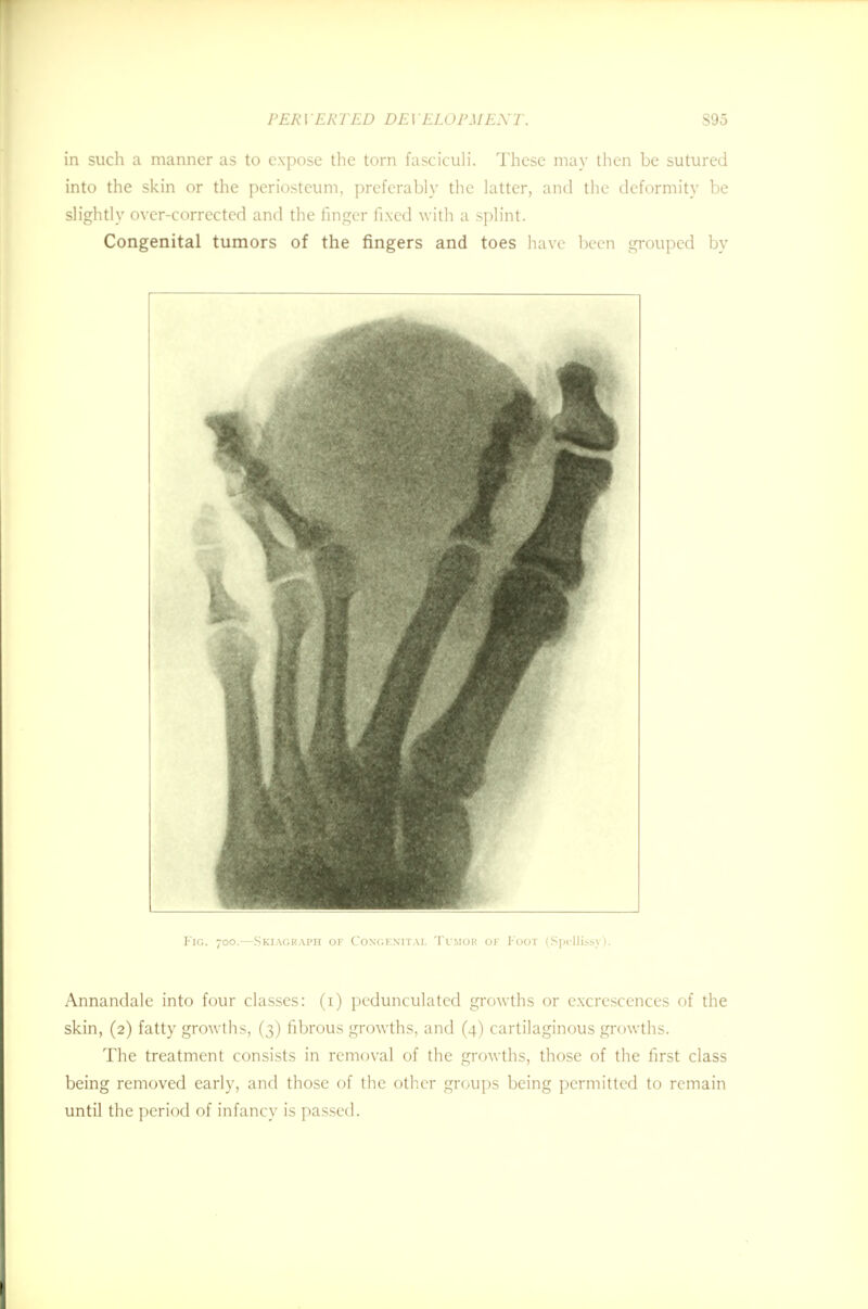 in such a manner as to expose the torn fasciculi. These may then be sutured into the skin or the periosteum, preferably the latter, and the deformity be slightly over-corrected and the finger fixed with a splint. Congenital tumors of the fingers and toes have been grouped by Fig. 700.—Skiagraph of Congenital Tumor of Foot (Spellissy). Annandale into four classes: (1) pedunculated growths or excrescences of the skin, (2) fatty growths, (3) fibrous growths, and (4) cartilaginous growths. The treatment consists in removal of the growths, those of the first class being removed early, and those of the other groups being permitted to remain until the period of infancy is passed.