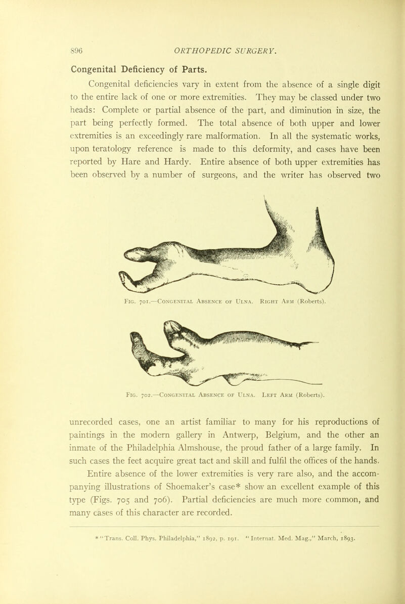 Congenital Deficiency of Parts. Congenital deficiencies vary in extent from the absence of a single digit to the entire lack of one or more extremities. They may be classed under two heads: Complete or partial absence of the part, and diminution in size, the part being perfectly formed. The total absence of both upper and lower extremities is an exceedingly rare malformation. In all the systematic works, upon teratology reference is made to this deformity, and cases have been reported by Hare and Hardy. Entire absence of both upper extremities has been observed by a number of surgeons, and the writer has observed two Fig. 701.—Congenital Absence of Ulna. Right Arm (Roberts). Fig. 702.—Congenital Absence of Ulna. Left Arm (Roberts). unrecorded cases, one an artist familiar to many for his reproductions of paintings in the modern gallery in Antwerp, Belgium, and the other an inmate of the Philadelphia Almshouse, the proud father of a large family. In such cases the feet acquire great tact and skill and fulfil the offices of the hands. Entire absence of the lower extremities is very rare also, and the accom- panying illustrations of Shoemaker's case* show an excellent example of this type (Figs. 705 and 706). Partial deficiencies are much more common, and many cases of this character are recorded. * Trans. Coll. Phys. Philadelphia, 1892, p. 191. Internat. Med. Mag., March, 1893.