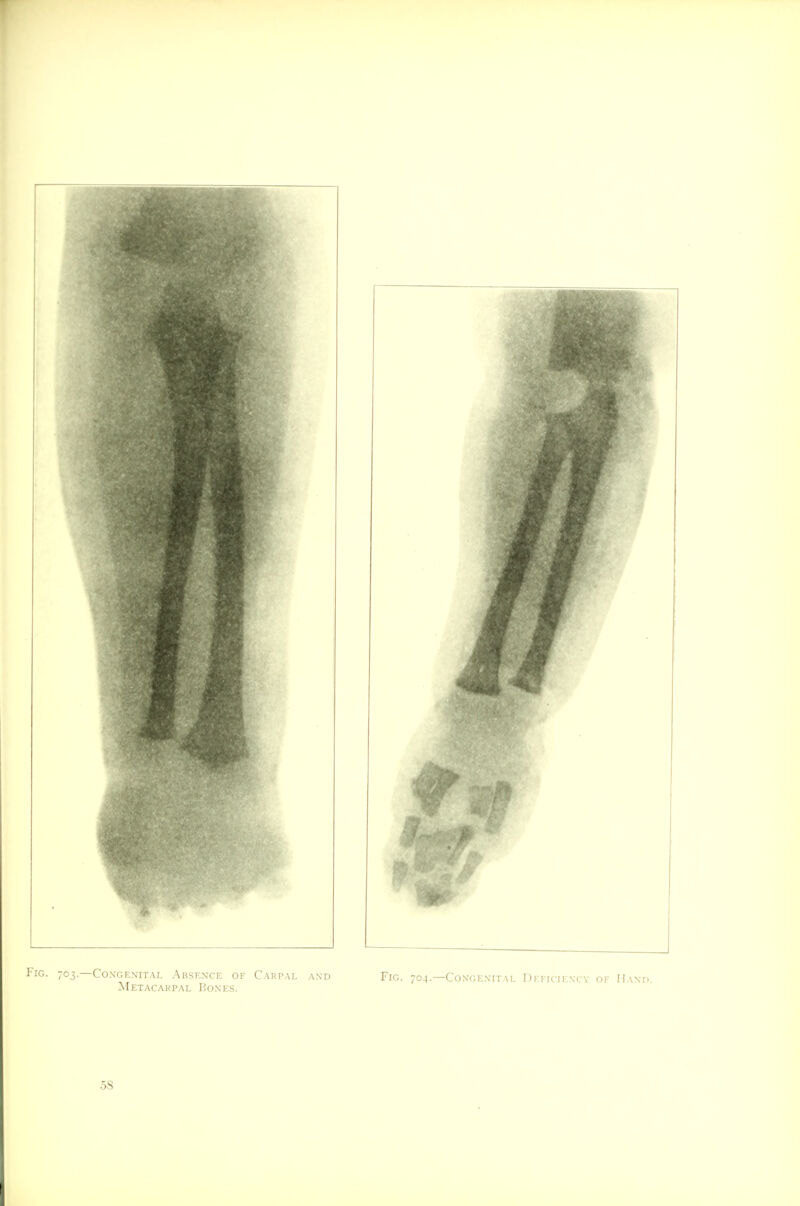 Congenital Absence of Carpal and Fig. 704.—Congenital Deficiency of Hand Metacarpal Hones. 58