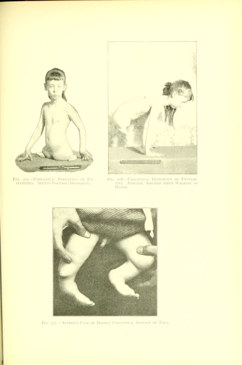 Fig. 707.—Author's Case of Double Congenital Absence of Tibia.