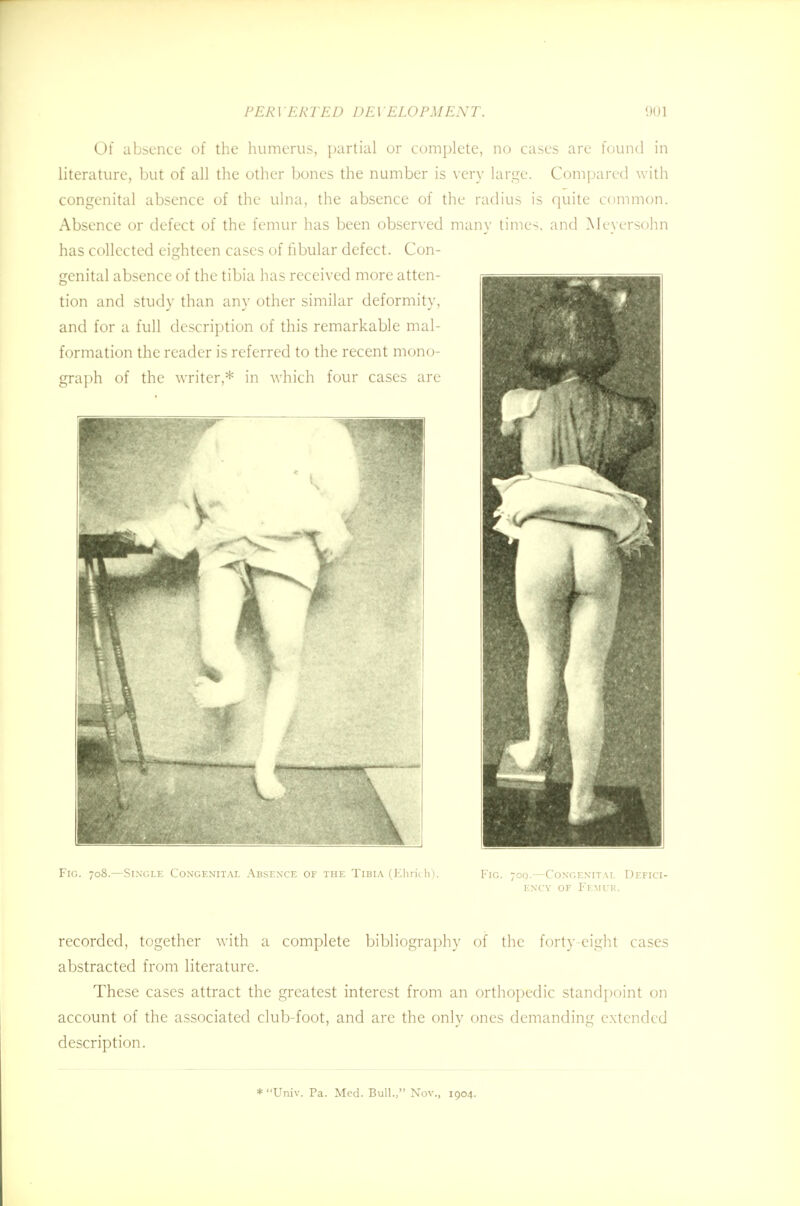 Of absence of the humerus, partial or complete, no cases are found in literature, but of all the other bones the number is very large. Compared with congenital absence of the ulna, the absence of the radius is quite common. Absence or defect of the femur has been observed many times, and Meyersohn has collected eighteen cases of fibular defect. Con- genital absence of the tibia has received more atten- tion and study than any other similar deformity, and for a full description of this remarkable mal- formation the reader is referred to the recent mono- graph of the writer,* in which four cases are Fig. 708.—Single Congenital Absence of the Tibia (Ehrich). Fig. 700.—Congenital Defici- ency of Femur. recorded, together with a complete bibliography of the forty eight cases abstracted from literature. These cases attract the greatest interest from an orthopedic standpoint on account of the associated club-foot, and arc the only ones demanding extended description. *Univ. Pa. Med. Bull., Nov., 1904.
