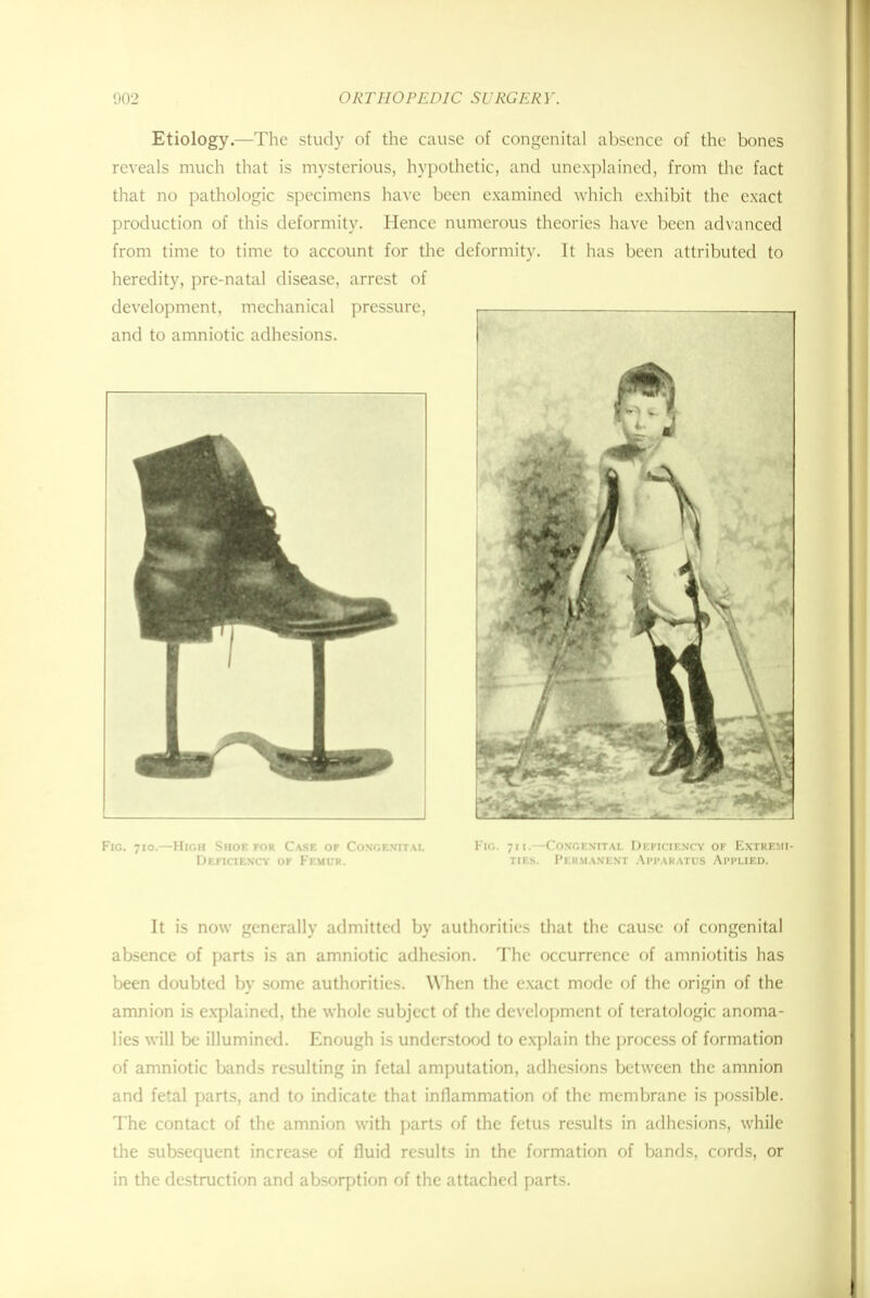 Etiology.—The study of the cause of congenital absence of the bones reveals much that is mysterious, hypothetic, and unexplained, from the fact that no pathologic specimens have been examined which exhibit the exact production of this deformity. Hence numerous theories have been advanced from time to time to account for the deformity. It has been attributed to heredity, pre-natal disease, arrest of development, mechanical pressure, , ___ and to amniotic adhesions. Fig. 710.—High Shoe for Case op Congenital Fig. 711.—CONGENITAL Deficiency of Extremi- Depiciency op Femur. ties. Permanent Apparatus Applied. It is now generally admitted by authorities that the cause of congenital absence of parts is an amniotic adhesion. The occurrence of amniotitis has been doubted by some authorities. When the exact mode of the origin of the amnion is explained, the whole subject of the development of teratologic anoma- lies will be illumined. Enough is understood to explain the process of formation of amniotic bands resulting in fetal amputation, adhesions between the amnion and fetal parts, and to indicate that inflammation of the membrane is possible. The contact of the amnion with parts of the fetus results in adhesions, while the subsequent increase of fluid results in the formation of bands, cords, or in the destruction and absorption of the attached parts.