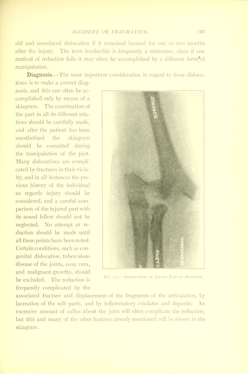 old and unreduced dislocation if it remained luxated for one or two months after the injury. The term irreducible is frequently a misnomer, since if one method of reduction fails it may often be accomplished by a different form'^of manipulation. Diagnosis.—The most important consideration in regard to these disloca- tions is to make a correct diag- nosis, and this can often be ac- complished only by means of a skiagram. The examination of the part in all its different rela- tions should be carefully made, and after the patient has been anesthetized the skiagram should be consulted during the manipulation of the part. Many dislocations are compli- cated by fractures in their vicin- ity, and in all instances the pre- vious history of the individual as regards injury should be considered, and a careful com- parison of the injured part with its sound fellow should not be neglected. No attempt at re- duction should be made until all these points have been noted. Certain conditions, such as con- genital dislocation, tuberculous disease of the joints, coxa vara, and malignant growths, should be excluded. The reduction is frequently complicated by the associated fracture and displacement of the fragments of the articulation, by laceration of the soft parts, and by inflammatory exudates and deposits. An excessive amount of callus about the joint will often complicate the reduction, but this and many of the other features already mentioned will be shown in the skiagram. Fig. ;n.—Dislocation of Lowkk End of Humerus.