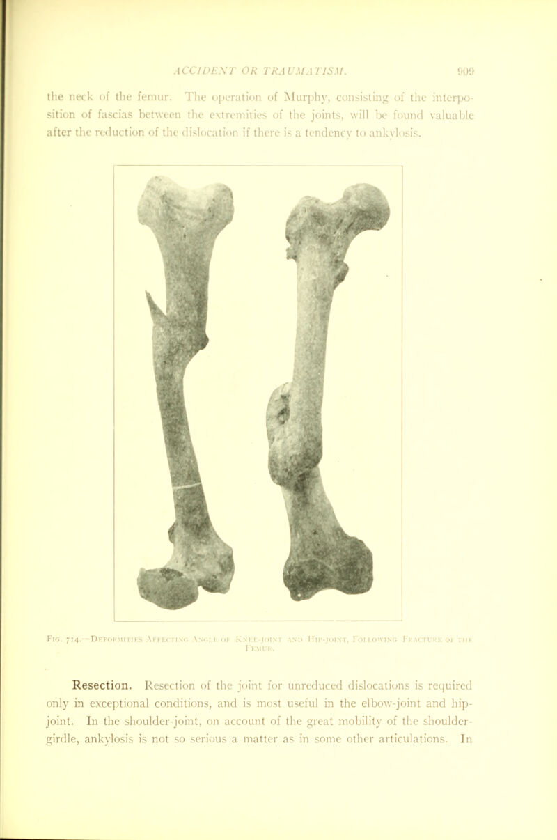 the neck of the femur. The operation of Murphy, consisting of the interpo- sition of fascias between the extremities of the joints, will be found valuable after the reduction of the dislocation if there is a tendency to ankylosis. Fig. 714.—Deformities Affecting Angle of Knee-joint and Hip-joint, Following Fracture of the Resection. Resection of the joint for unreduced dislocations is required only in exceptional conditions, and is most useful in the elbow-joint and hip- joint. In the shoulder-joint, on account of the great mobility of the shoulder- girdle, ankylosis is not so serious a matter as in some other articulations. In