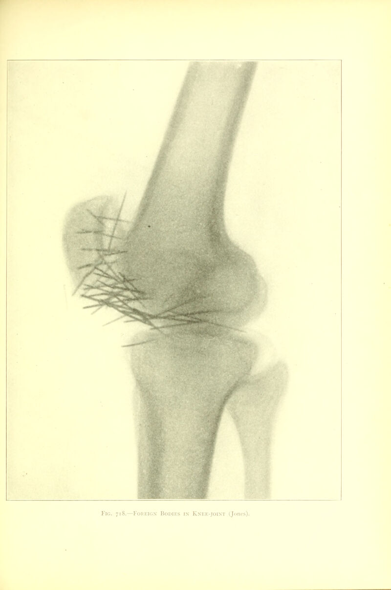 Fig. 718.—Foreign- Bodies in- Knee-joint (Jones).