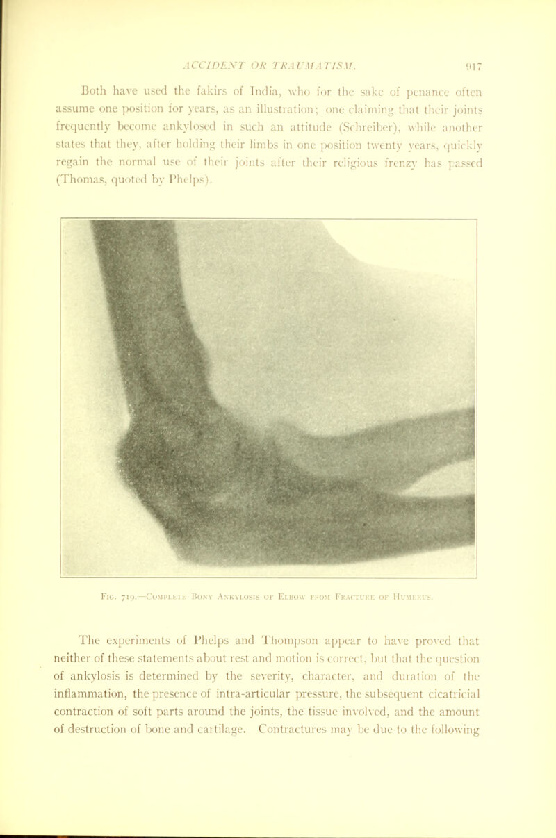 Both have used the fakirs of India, who for the sake of penance often assume one position for years, as an illustration; one claiming that their joints frequently become ankylosed in such an attitude (Schreibcr), while another states that they, after holding their limbs in one position twenty years, quickly regain the normal use of their joints after their religious frenzy has passed (Thomas, quoted by Phelps). Fig. 719.—Complete Bony Ankylosis of Elbow from Fracture of Humerus. The experiments of Phelps and Thompson appear to have proved that neither of these statements about rest and motion is correct, but that the question of ankylosis is determined by the severity, character, and duration of the inflammation, the presence of intra-articular pressure, the subsequent cicatricial contraction of soft parts around the joints, the tissue involved, and the amount of destruction of bone and cartilage. Contractures may be due to the following