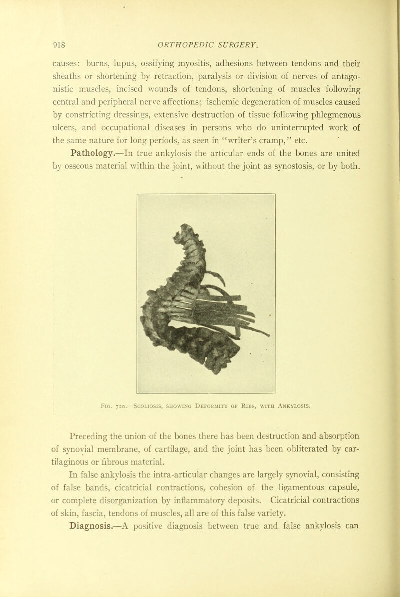 causes: burns, lupus, ossifying myositis, adhesions between tendons and their sheaths or shortening by retraction, paralysis or division of nerves of antago- nistic muscles, incised wounds of tendons, shortening of muscles following central and peripheral nerve affections; ischemic degeneration of muscles caused by constricting dressings, extensive destruction of tissue following phlegmenous ulcers, and occupational diseases in persons who do uninterrupted work of the same nature for long periods, as seen in writer's cramp, etc. Pathology.—In true ankylosis the articular ends of the bones are united by osseous material within the joint, without the joint as synostosis, or by both. Fig. 720.—Scoliosis, showing Deformity of Ribs, with Ankylosis. Preceding the union of the bones there has been destruction and absorption of synovial membrane, of cartilage, and the joint has been obliterated by car- tilaginous or fibrous material. In false ankylosis the intra-articular changes are largely synovial, consisting of false bands, cicatricial contractions, cohesion of the ligamentous capsule, or complete disorganization by inflammatory deposits. Cicatricial contractions of skin, fascia, tendons of muscles, all are of this false variety. Diagnosis.—A positive diagnosis between true and false ankylosis can