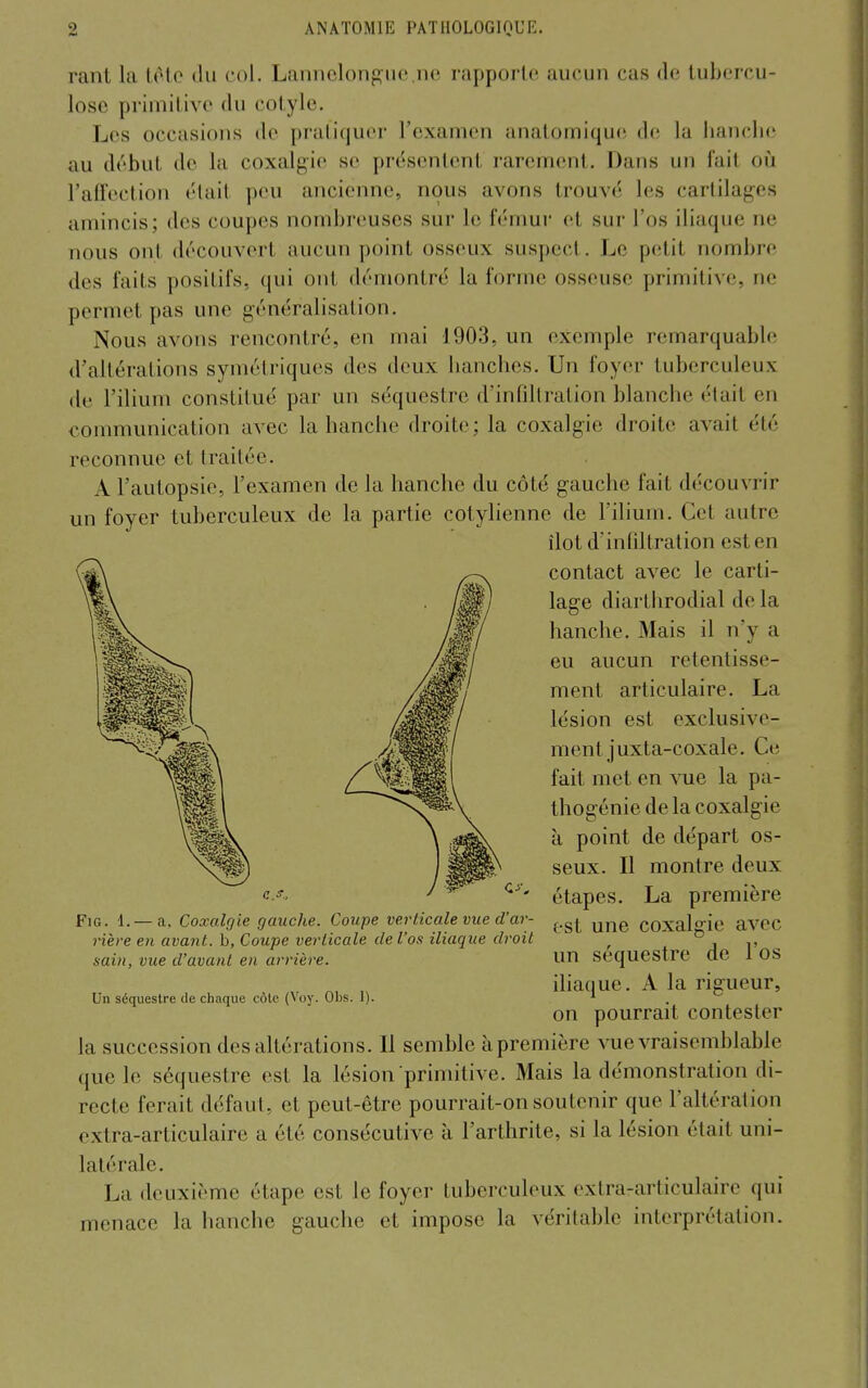 rant la lôtc du col. Lannclongiic nc rapporte aucun cas de tubercu- lose primitive du cotyle. Les occasions de pratiquer l'examen analomique de la hanche au début de la coxalgie se présentent rarement. Dans un fait où l'aH'ection était peu ancienne, nous avons trouvé les cartilages amincis; des coupes nombreuses sur le fénmr et sur l'os iliaque ne nous ont découvert aucun point osseux suspect. Le petit nombre des faits positifs, qui ont démontré la forme osseuse primitive, ne permet pas une généralisation. Nous avons rencontré, en mai 1903, un exemple remarquable d'altérations symétriques des deux hanches. Un foyer tuberculeux de l'ilium constitué par un séquestre d'infiltration blanche «'tait en communication avec la hanche droite; la coxalgie droite avait été reconnue et traitée. A l'autopsie, l'examen de la hanche du côté gauche fait découvrir un foyer tuberculeux de la partie cotylienne de l'ilium. Cet autre îlot d'infiltration est en contact avec le carti- lage diarlhrodial de la hanche. Mais il n'y a eu aucun retentisse- ment articulaire. La lésion est exclusive- ment juxta-coxale. Ce fait met en vue la pa- thogénie de la coxalgie à point de départ os- seux. Il montre deux étapes. La première est une coxalgie avec un séquestre de l'os iliaque. A la rigueur, on pourrait contester la succession des altérations. Il semble àpremière vue vraisemblable que le séquestre est la lésion primitive. Mais la démonstration di- recte ferait défaut, et peut-être pourrait-on soutenir que l'altération extra-articulaire a été consécutive à l'arthrite, si la lésion était uni- latérale. La deuxième étape est le foyer tuberculeux extra-articulaire qui menace la hanche gauche et impose la véritable interprétation. FiG. 1.— a, Coxalgie gaudie. Coupe verticale vue d'ar- rière en avant, b, Coupe verticale de l'os iliaque droit sain, vite d'avant en arrière. Un séquestre de chaque côte (Voy. Obs. I).