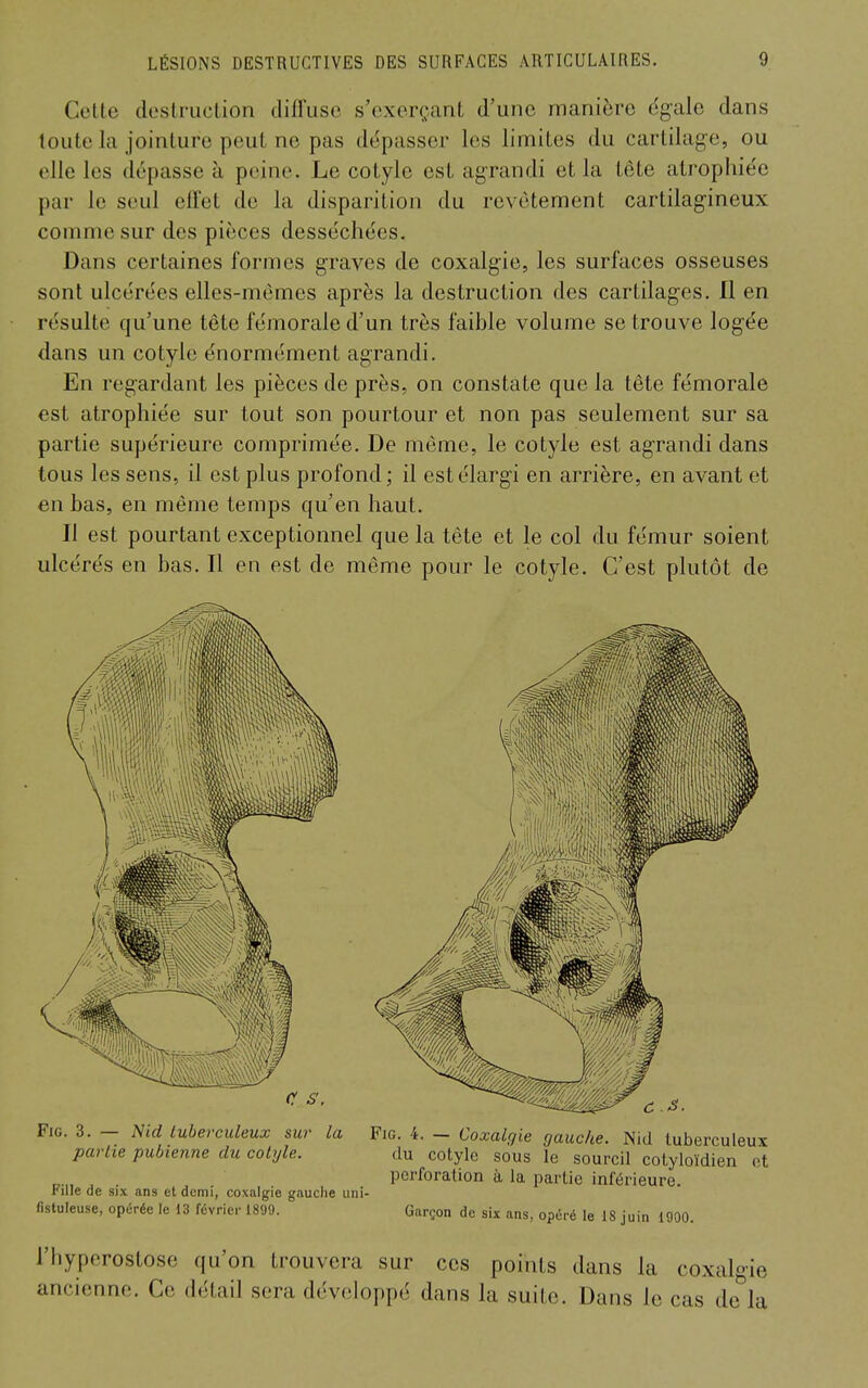 Celte destruction diffuse s'exerçant d'une manière égale dans toute la jointure peut ne pas dépasser les limites du cartilage, ou elle les dépasse à peine. Le cotyle est agrandi et la tête atrophiée par le seul effet de la disparition du revêtement cartilagineux comme sur des pièces desséchées. Dans certaines formes graves de coxalgie, les surfaces osseuses sont ulcérées elles-mêmes après la destruction des cartilages. Il en résulte qu'une tête fémorale d'un très faible volume se trouve logée dans un cotyle énormément agrandi. En regardant les pièces de près, on constate que la tête fémorale est atrophiée sur tout son pourtour et non pas seulement sur sa partie supérieure comprimée. De même, le cotyle est agrandi dans tous les sens, il est plus profond; il est élargi en arrière, en avant et en bas, en même temps qu'en haut. Il est pourtant exceptionnel que la tête et le col du fémur soient ulcérés en bas. Il en est de même pour le cotyle. C'est plutôt de FiG. 3. — Nid tuberculeux sw la Fig. 4. — Coxalgie gauche. Nid tuberculeux parlie pubienne du cotyle. du cotyle sous le sourcil cotyloïdien et perforation à la partie inférieure. rillede six ans et demi, coxalgie gauche urii- fistuleuse, opérée le 13 février 1899. Garçon de six ans, opéré le 18 juin 1900. l'hyperostose qu'on trouvera sur ces points dans la coxalgie ancienne. Ce détail sera développé dans la suite. Dans le cas de^a