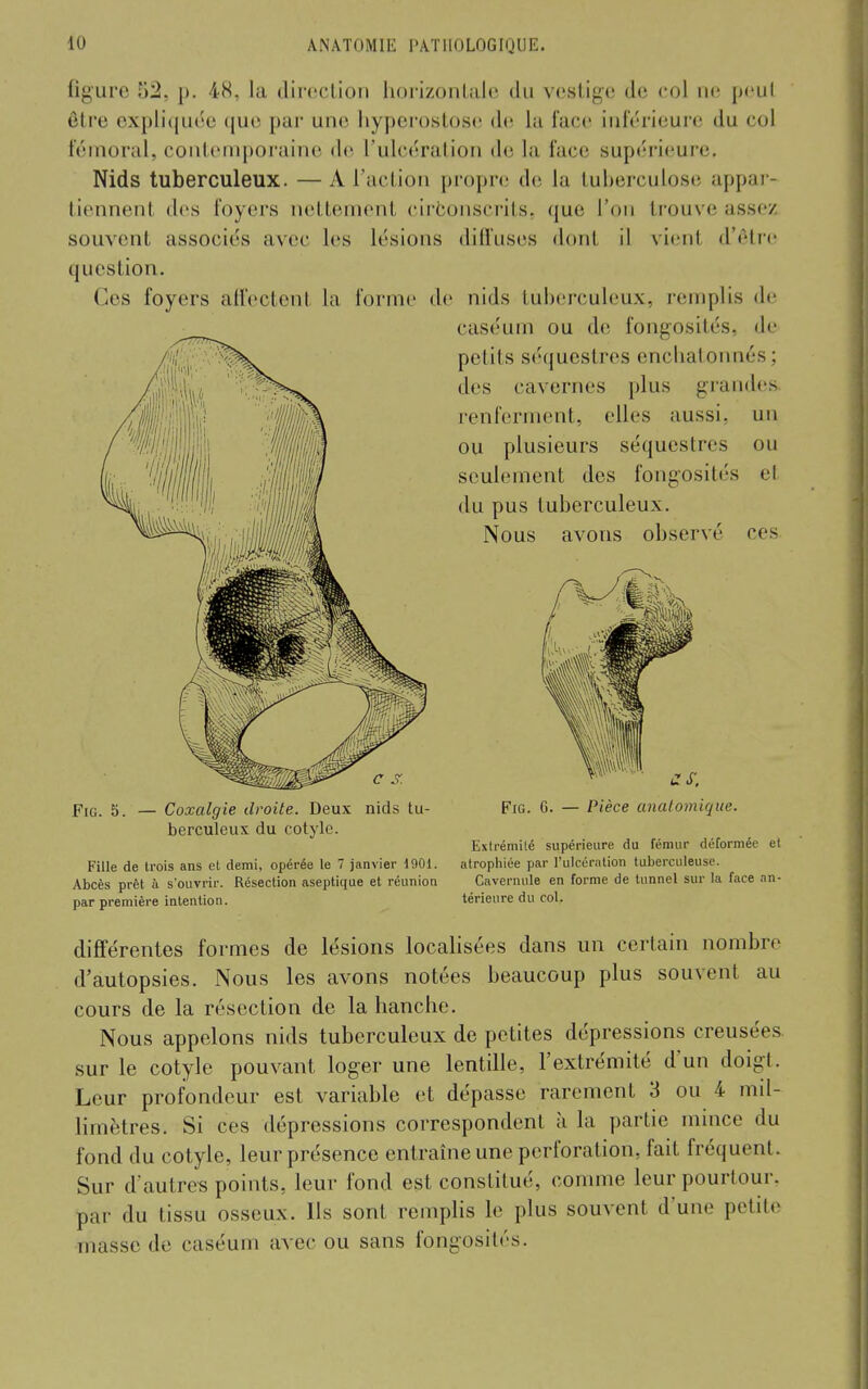 figure 52, p. 48, la direclion horizonUilc du vestige de col ne pcul être ox[)li((uée que par une liyperostos(! de la face inférieure du col fémoral, contemporaine de l'ulcération de la face supérieure. Nids tuberculeux. — A l'action propre de la tuberculose appar- tiennent des foyers nettement cirtonscrits, que l'on trouve assez souvent associés avec les lésions diffuses dont il vient d'être question. Ces foyers affectent la forme de nids tuberculeux, remplis de cas('um ou de fongosités, de petits séquestres encbatonnés; des cavernes plus gi-andes renferment, elles aussi, un ou plusieurs séquestres ou seulement des fongosités el du pus tuberculeux. Nous avons observé ces FiG. 5. — Coxalgie droite. Deux nids tu- berculeux du cotyle. Fille de trois ans et demi, opérée le 7 janvier 1001. Abcès prêt à s'ouvrir. Résection aseptique et réunion par première intention. FiG. G. — Pièce analomique. Extrémité supérieure du fémur déformée et atrophiée par l'ulcération tuberculeuse. Cavernule en forme de tunnel sur la face an- térieure du col. dijBFérentes formes de lésions localisées dans un certain nombre d'autopsies. Nous les avons notées beaucoup plus souvent au cours de la résection de la hanche. Nous appelons nids tuberculeux de petites dépressions creusées, sur le cotyle pouvant loger une lentille, l'extrémité d'un doigt. Leur profondeur est variable et dépasse rarement 3 ou 4 mil- limètres. Si ces dépressions correspondent à la partie mmce du fond du cotyle, leur présence entraîne une perforation, fait fréquent. Sur d'autres points, leur fond est constitué, comme leur pourtour, par du tissu osseux. Ils sont rempHs le plus souvent d'une petite masse de caséum avec ou sans fongosités.