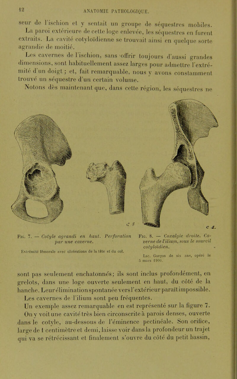 seur do l'ischion ol y sontait un groupe de séquestres mobiles. La paroi extérieure de celle logo enlevée, les séquestres en furent extraits. La cavité cotyloïdienne se trouvait ainsi en quelque sorte agrandie de moitié. Les cavernes de l'ischion, sans -offrir toujours d'aussi grandes dimensions, sont habituellement assez larges pour admettre l'extré- mité d'im doigt ; et, fait remarquable, nous y avons constamment trouvé un séquestre d'un certain volume. Notons dès maintenant que, dans cette région, les séquestres ne FiG. 7. — Colyle agrandi en haut. Perforation Fia. 8. — Coxalgie droite. Ca- par une caverne. ' verne de l'iliuni, sous le sourcil cotyloïdien. Extrémité fémorale avec ulcérations de la tête et du col. Lac. Garçon de six an?, opéré le a mars 1900. sont pas seulement enchatonnés; ils sont inclus profondément, en grelots, dans une loge ouverte seulement en haut, du côté de la hanche. Leur éliminationspontanéeversTextérieurparaîtimpossible. Les cavernes de l'ilium sont peu fréquentes. Un exemple assez remarquable en est représenté sur la figure 7. On y voit une cavité très bien circonscrite à parois denses, ouverte dans le cotyle, au-dessous de l'éminence pectinéale. Son orifice, large de 1 centimètre et demi, laisse voir dans la profondeur un trajet qui va se rétrécissant et finalement s'ouvre du côté du petit bassin,