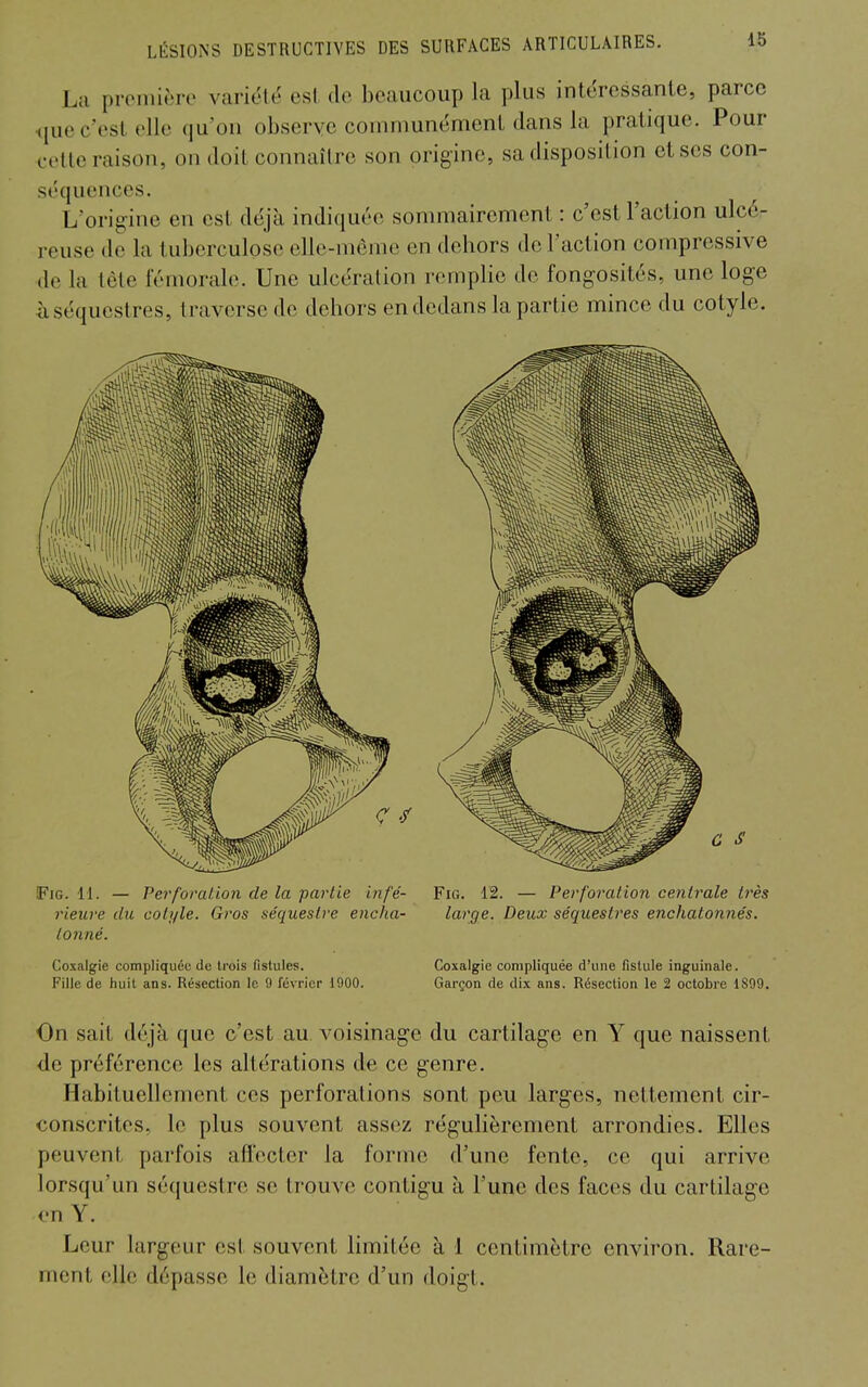 La pronn»)re variëlé esl de beaucoup la plus intéressante, parce que c'est elle qu'on observe communément dans la pratique. Pour celle raison, on doil connaître son origine, sa disposition et ses con- séquences. L'origine en est déjà indiquée sommairement : c'est l'action ulcé- reuse de la tuberculose elle-même en dehors de l'action compressive de la tète fémorale. Une ulcération remplie de fongosités, une loge à séquestres, traverse de dehors en dedans la partie mince du cotyle. FiG. 11. — Perforation de la partie infé- rieure du colyle. Gros séquestre encha- lonné. Coxalgie compliquée de trois fistules. Fille de huit ans. Résection le 9 février 1900. large. Deux séquestres enchatonnés. Coxalgie compliquée d'une fistule inguinale. Garçon de dix ans. Résection le 2 octobre 1899. On sait déjà que c'est au. voisinage du cartilage en Y que naissent •de préférence les altérations de ce genre. Habituellement ces perforations sont peu larges, nettement cir- conscrites, le plus souvent assez régulièrement arrondies. Elles peuvent parfois affecter la forme d'une fente, ce qui arrive lorsqu'un séquestre se trouve contigu à l'une des faces du cartilage en Y. Leur largeur est souvent limitée à 1 centimètre environ. Rare- ment elle dépasse le diamètre d'un doigt.