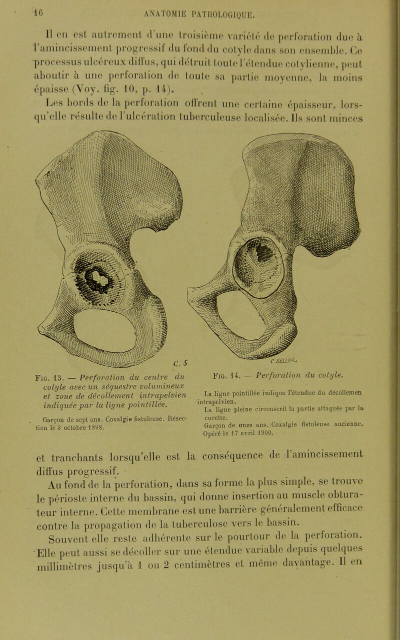 11 en est aulro.mont d'une troisième variété de perforation duo à Tamincissernent progressif du fond du cotyle dans son cnsenil)le. Ce processus ulcéreux dilfus, qui détruit touteTétendue cotylienne, peut aboutir à une perforation de toute sa j)arli(! moyenne, la moins épaisse (Voy. iig. 10, p. 14). Les bords de la perforation offrent une cerlaine épaisseui-, lors- qu'elle résulte de l'ulcération tuberculeuse localisée. Ils sont minces FiG. 13. — Perforation du centre du cotyle avec un séquestre volumineux et zone de décollement intrapelvien indiquée par la ligne poinlillée. Garçon de sept ans. Coxalgie fistuleuse. Résec- tion le 3 octobre 1898. FiG. 14. — Perforation du cotyle. La ligne poinlillée indique l'étendue du décollemen intrapelvien. La ligne pleine circonscrit la partie attaquée par la curette. Garçon de onze ans. Coxalgie fistuleuse ancienne. Opéré le 17 avril 1900. et tranchants lorsqu'elle est la conséquence de l'amincissement diffus progressif. Au fond de la perforation, dans sa forme la plus simple, se trouve le périoste interne du bassin, qui donne insertion au muscle obtura- teur interne. Cette membrane est une barrière généralement efficace contre la propagation de la tuberculose vers le bassm. Souvent elle reste adhérente sur le pourtour de la perforation. Elle peut aussi se décoller sur une étendue variable depuis quelques