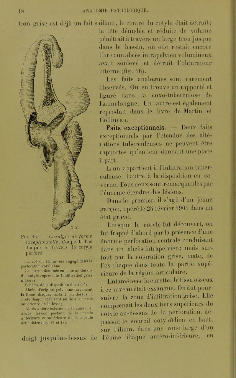 tion gris(> csl déjà un fail FiG. 16. — Coxalgie de forme exceptionnelle. Coupe de l'os iliaque à travers le cotyle perforé. Le col du fémur est engagé dons la perforation cotyliennc. La partie dessinée en clair au-dessus du cotyle représente l'infiltration grise massive. Schéma de la disposition des abcè<. Abcès d'origine pelvienne traversant la fosse iliaque, sortant par-dessus la crèle iliaque et faisant saillie à la partie supérieure de la fesse; Abcès antéro-externo de la cuisse, et abcès fessier parlant de la partie antérieure et supérieure de la capsule articulaire (lig. 17 et 18). doigt jusqu'au-dossus de saillaiil, le ccnlro du cotyle était d«itruil; la Irle dénudée et réduite de volume p«''aétrait ù travers un large li-ou jus(jue dans le bassin, ofi elle restait encore lihrcî : un abcès iiitrapelvien volumineux avait soulevé et détruit l'obturateur interne (fig. Ki). Les faits analogues sont rarement observés. On en trouve un rapporté et liguré dans la coxo-tubcrculose de Lannelongue. Un autre est également reproduit dans le livre de Martin et Gollineau. Faits exceptionnels. — Deux faits exceptionnels par l'étendue des alté- rations tuberculeuses ne peuvent être rapportés qu'en leur donnant une place à part. L un appartient à l'infiltration tuber- culeuse, l'autre à la disposition en ca- verne. Tous deux sont remarquables par l'énorme étendue des lésions. Dans le premier, il s'agit d'un jeune garçon, opéré le 25 février 1901 dans un état grave. Lorsque le cotyle fut découvert, on fut frappé d'abord par la présence d'une énorme perforation centrale conduisant dans un abcès intrapelvien; mais sur- tout par la coloration grise, mate, de l'os iliaque dans toute la partie supé- rieure de la région articulaire. Entamé avec la curette, le tissu osseux à ce niveau était exsangue. On dut pour- suivre la zone d'infiltration grise. Elle comprenait les deux tiers supérieurs du cotyle au-dessus de la perforation, dé- passait le sourcil cotyloïdien en baut, sur l'ilium, dans une zone large d'un l'épine iliaque antéro-inférieure, en