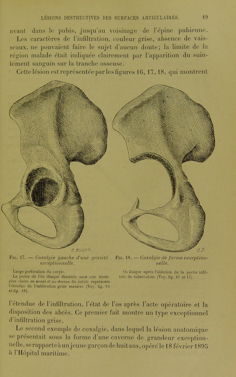 avant dans le pubis, jusqu'au voisinago de l'opiné pubienne. Les caractères de l'infiltration, couleur grise, absence de vais- seaux, ne pouvaient faire le sujet d'aucun doute; la limite de la région malade était indiquée clairement par l'apparition du suin- tement sanguin sur la tranche osseuse. Cette lésion est représentée parles figures 16, 17,18, (|ui montrent Fjg. 17. — Coxalgie gauche d'une gravité Fie. 18. — Coxalgie de forme excepLion- excepiionnelle. nelle. Large perforation du colylc. Os iliaque après l'ablation de la partie infil- La partie de l'os iliaque dessinée sous une teinte Iréi? de tuberculose (Voy. fig. IG et 17). plus claire en avant et au-dessus du cotylo représente l étonduo de l'infilli'ation grise massive (Voy. fig. 10 etfig. 18). l'étendue de l'infiltration, l'e'tat de l'os après l'acte opératoire et la disposition des abcès. Ce premier fait montre un type exceptionnel d'infiltration grise. Le second exemple de coxalgie, dans lequel la lésion anatomiquc se présentait sous la forme d'une caverne de grandeur exception- nelle, serapporteàun jeune garçon de huitans, opéré le 18 févriei- \ 895 a l'Hôpital maritime.