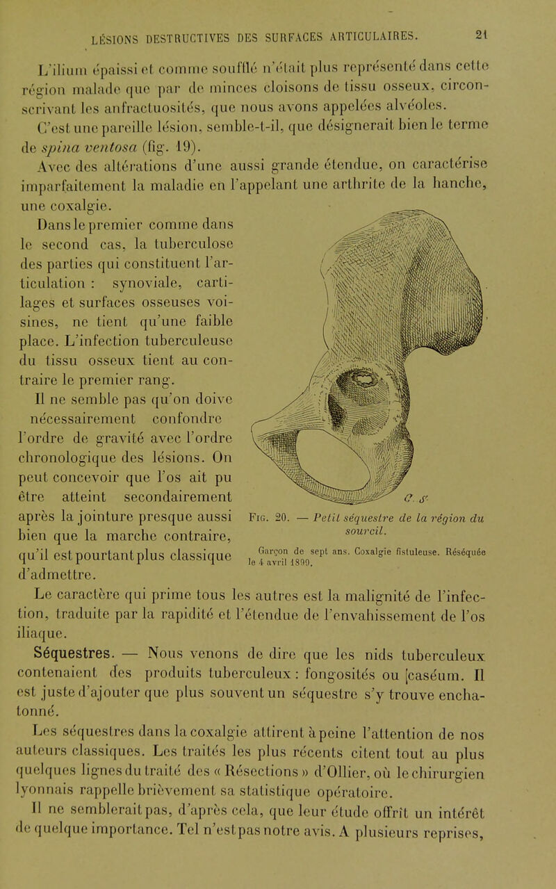 L'iliuiii épaissi et cominc soiifllé n'cUait plus représenté dans cette région malade que par de minces cloisons de tissu osseux, circon- scrivant les anfractuosités, que nous avons appelées alvéoles. C'est une pareille lésion, semble-t-il, que désignerait bien le terme de spina ventosa (fig. 19). Avec des altéi'ations d'une aussi grande étendue, on caractérise imparfaitement la maladie en l'appelant une arthrite de la hanche, une coxalgie. Dans le premier comme dans le second cas, la tuberculose des parties qui constituent l'ar- ticulation : synoviale, carti- lages et surfaces osseuses voi- sines, ne tient qu'une faible place. L'infection tuberculeuse du tissu osseux tient au con- traire le premier rang. Il ne semble pas qu'on doive nécessairement confondre Tordre de gravité avec l'ordre chronologique des lésions. On peut concevoir que l'os ait pu être atteint secondairement après la jointure presque aussi Fig. 20. — Pet'U séquestre de la région du bien que la marche contraire, sourcil. qu'il est pourtant plus classique ,^ fi^iuieuse. Réséquée d'admettre. Le caractère qui prime tous les autres est la malignité de l'infec- tion, traduite par la rapidité et l'étendue de l'envahissement de l'os iliaque. Séquestres. — Nous venons de dire que les nids tuberculeux contenaient des produits tuberculeux : fongosités ou [caséum. Il est juste d'ajouter que plus souvent un séquestre s'y trouve encha- tonné. Les séquestres dans la coxalgie attirent à peine l'attention de nos auteurs classiques. Les traités les plus récents citent tout au plus quelques lignes du traité des « Résections » d'Ollier, où le chirurgien lyonnais rappelle brièvement sa statistique opératoire. II ne semblerait pas, d'après cela, que leur étude offrît un intérêt de quelque importance. Tel n'estpas notre avis. A plusieurs reprises,