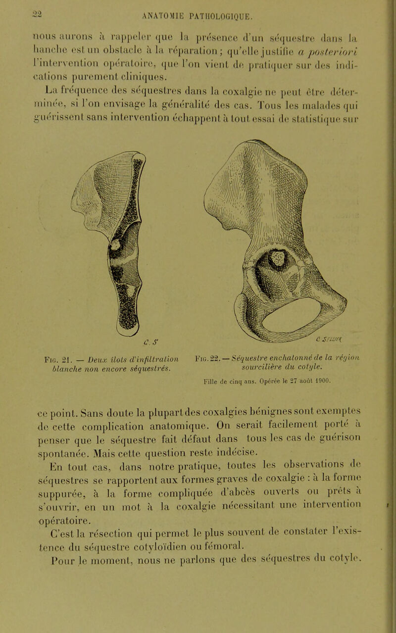 nous aurons à rappelor quo la pre:sonce d'un stMjuostro dans la luinclic est un obslaele à la, roparalion ; qu'elle jusUlie a posteriori l'intervention opératoire, que l'on vient de pratiquer sur des indi- cations purement cliniques. La fréquence des séquestres dans la coxalgie ne peut être déter- minée, si l'on envisage la généralité des cas. Tous les malades qui guérissent sans intervention échappent à tout essai de statistique sur FiG. 21. — Deux ilôts d'infillralion Fia. 22. —Séquestre eiic/iatonné de la réf/lnn blanche non encore séquestrés. sourcilière du colyle. Fille (le cinq ans. Opérée le 27 aoiH 1900. ce point. Sans doute la plupart des coxalgies bénignes sont exemptes do cette complication anatomique. On serait facilement porté à penser que le séquestre fait défaut dans tous les cas de guérison spontanée. Mais cette question reste indécise. En tout cas, dans notre pratique, toutes les observations de séquestres se rapportent aux formes graves de coxalgie : à la forme suppurée, à la forme compliquée d'abcès ouverts ou prêts à s'ouvrir, en un mot à la coxalgie nécessitant une intervention opératoire. C'est la résection qui permet le plus souvent de constater l'exis- tence du séquestre cotyloïdien ou fémoral. Pour le moment, nous ne parlons que des séquestres du cotyle.