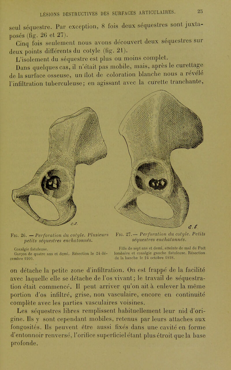 seul sé(iu('sl,re. Par cxcepLion, 8 fois doux séquestres sont juxta- posés (fig. 20 et 21). Cinq fois seulenicnt nous avons découvert deux séquestres sur deux points dillérents du cotyle (tig'. 21). L'isolement du séquestre est plus ou moins complet. Dans quelques cas, il n'était pas mobile, mais, après le curettagc de la surface osseuse, un îlot de coloration blanche nous a révélé l'infiltration tuberculeuse; en agissant avec la curette tranchante, FiG. 2G. — Perforation du colyle. Plusieurs petits séquestres enchatonnés. Coxalgie fistuleuse. Garçon de quatre ans et demi. Résection le 24 dé- cembre 1900. Fjg. 27.— Perforation du cotyle. Petits séquestres enchatonnés. Fille de sept ans et demi, atteinte de mal de Pott lombaire et coxalgie gauche fistuleuse. Résection de la hanche le 24 octobre 1S98. on détache la petite zone d'infiltration. On est frappé de la facihté avec laquelle elle se détache de l'os vivant ; le travail de séquestra- tion était commencé. Il peut arriver qu'on ait à enlever la même portion d'os infiltré, grise, non vasculaire, encore en continuité complète avec les parties vasculaires voisines. Les séquestres libres remplissent habituellement leur nid d'ori- gine. Ils y sont cependant mobiles, retenus par leurs attaches aux fongosités. Us peuvent être aussi fixés dans une cavité en forme d'entonnoir renversé, l'orifice superliciel étant plus étroit que la base profonde.