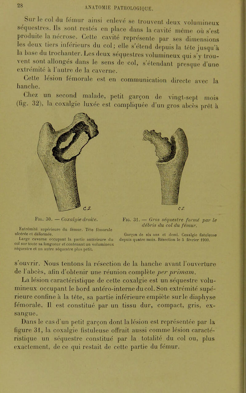 Sur le col (lu Icmur ainsi enlevé se trouvent Jeux volumineux séquestres. Ils sont resti's en place dans la cavité niènie où s'est produite la nécrose. Cette cavité représente par ses dimensions les deux tiers inférieurs du col; elle s'ét(;nd depuis la tête jusqu'à la base du troclianter. Les deux séquestres volumineux qui s'y trou- vent sont allongés dans le sens de col, s'étendant presque d'une extrémité à l'autre de la caverne. Cette lésion fémorale est en communication directe avec la hanche. Chez un second malade, petit garçon de vingt-sept mois (fig. 32), la coxalgie luxée est compliquée d'un gros ahchs prêt à Fk;. 30. —Coxalgie droite. Fig. 31. — Gros séquestre formé par le débris du col du fémur. Extrémité supérieure du fémur. Tèle fémorale ulcérée et déformée. Garçon de six ans et demi. Coxalgie fistuleuse Large caverne occupant la partie antérieure du depuis quatre mois. Résection le 5 février 1900. col sur toute sa longueur et contenant un volumineux séquestre et un autre séquestre plus petit. s'ouvrir. Nous tentons la résection de la hanche avant l'ouverture de l'abcès, afin d'obtenir une réunion complète per primam. La lésion caractéristique de cette coxalgie est un séquestre volu- mineux occupant le bord antéro-interneducol. Son extrémité supé- rieure confine à la tête, sa partie inférieure empiète sur le diaphyse fémorale. Il est constitué par un tissu dur, compact, gris, ex- sangue. Dans le cas d'un petit garçon dont la lésion est représentée par la figure 31, la coxalgie fistuleuse olïrait aussi comme lésion caracté- ristique un séquestre constitué par la totalité du col ou, plus exactement, de ce qui restait de cette partie du fémur.