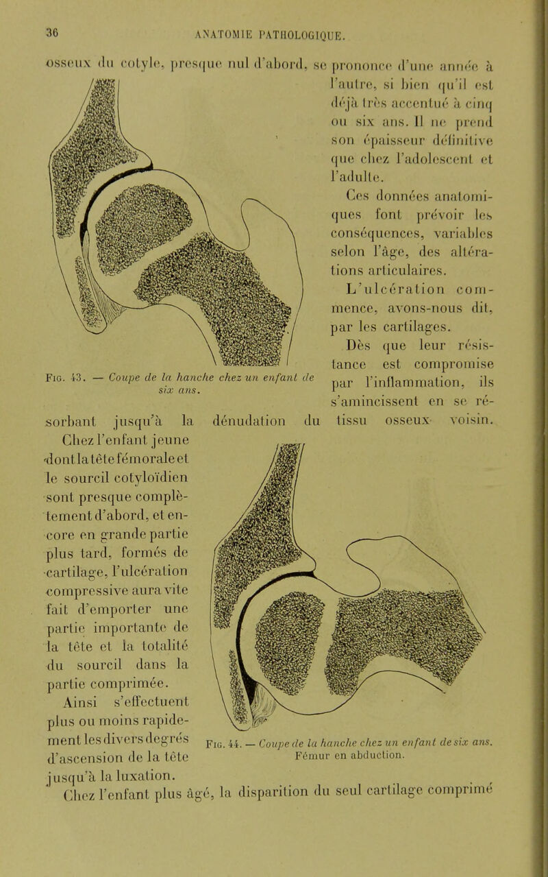 osseux (lu colylc, |)ros(|ii(' nul d'abord, si! prononco d'uno année à l'autre, si bien (|u'ii est déjà Irès accentué h cinq ou six ans. 11 ne; prend son épaisseur délinilive (|ue cbez l'adolescent et l'adulle. Ces données anatomi- ques font prévoir les conséquences, variables selon l'âge, des altéra- tions articulaires. L'ulcération com- mence, avons-nous dit, par les cartilages. Dès que leur résis- tance est compromise par l'inflammation, ils s'amincissent en se ré- tissu osseux voisin. FiG. 43. — Coupe de la hanche chez un enfant de six ans. jsorbant jusqu'à la dénudation du Chez l'enfant jeune 'dontla tête fémorale et le sourcil cotyloïdien sont presque complè- tement d'abord, et en- core en grande partie plus tard, formés de ■cartilage, l'ulcération compressive aura vite fait d'emporter une partie importante de la tête et la totalité du sourcil dans la partie comprimée. Ainsi s'effectuent plus ou moins rapide- ment les divers degrés d'ascension de la tête jusqu'à la luxation. Clicz l'enfant plus âgé, la disparition du seul cartilage comprimé FiG. 44. — Coupe de la hanche chez un enfant de six a?w. Fémur en abduction.