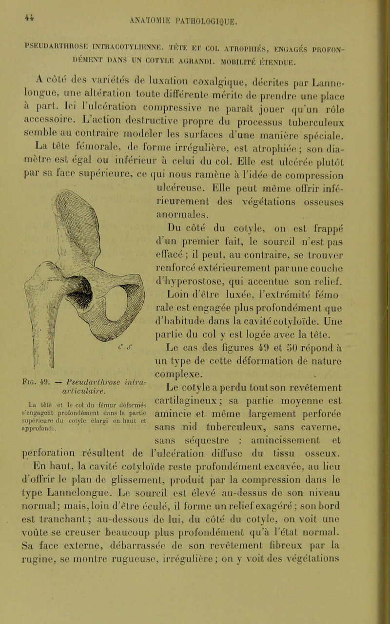 PSEUDAllTHROSK INTIIACOTYI.IICNNR. TlÎTE ET COL ATROPHIÉS, ENfUGKS PROFON- DÉMENT DANS UN COTYI.R AdRANDl. MOBILITÉ ÉTENDUE. A côté des varioles de luxation coxalgique, décrites par Lannc- long^uc, une altération toute difl'érente mérite de prendre une place à part. Ici l'ulcération compressive ne paraît jouer qu'un rôle accessoire. L'action destructive propre du processus tuberculeux semble au contraire modeler les surfaces d'une manière spéciale. La tête fémorale, de forme irrégulière, est atrophiée ; son dia- mètre est égal ou inférieur à celui du col. Elle est ulcérée plutôt par sa face supérieure, ce qui nous ramène à l'idée de compression ulcéreuse. Elle peut môme offrir infé- rieurement des végétations osseuses anormales. Du côté du cotyle, on est frappé d'un premier fait, le sourcil n'est pas elTacé; il peut, au contraire, se trouver renforcé extérieurement par une couche d'hyperostose, qui accentue son relief. Loin d'être luxée, l'extrémité fémo raie est engagée plus profondément que d'habitude dans la cavité cotyloïde. Une partie du col y est logée avec la tête. Le cas des figures 49 et 50 répond à un type de cette déformation de nature complexe. Le cotyle a perdu tout son revêtement La tête et le col au fémur déformés carlikgineux ; sa partie moyenne est s'engagent profondément dans la partie amincio et même largement porforéc supérieure du colyle élargi en haut el • i i i approfondi. saus uid tubcrculeux, sans caverne, sans séquestre : amincissement et perforation résultent de l'ulcération diiï'use du tissu osseux. En haut, la cavité cotyloïde reste profondément excavée, au lieu d'offrir le plan de glissement, produit par la compression dans le type Lannelongue. Le sourcil est élevé au-dessus de son niveau normal; mais, loin d'être éculé, il forme un relief exagéré ; son bord est tranchant; au-dessous de lui, du côté du cotyle, on voit une voûte se creuser beaucoup plus profondément qu'à l'état normal. Sa face externe, débarrassée de son revêlement fibreux par la rugine, se montre rugueuse, irrégulière ; on y voit des végétations articulaire.