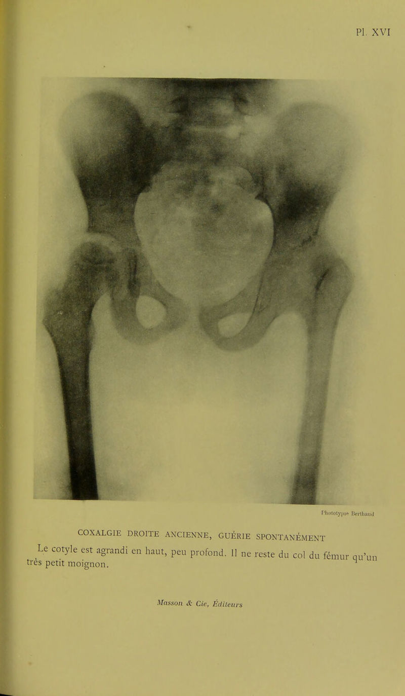 l'liiil(ily|il'> l'.ellliaild COXALGIE DROITE ANCIENNE, GUÉRIE SPONTANÉMENT Le cotyle est agrandi en haut, peu profond. Il ne reste du col du fémur qu'un très petit moignon. ^