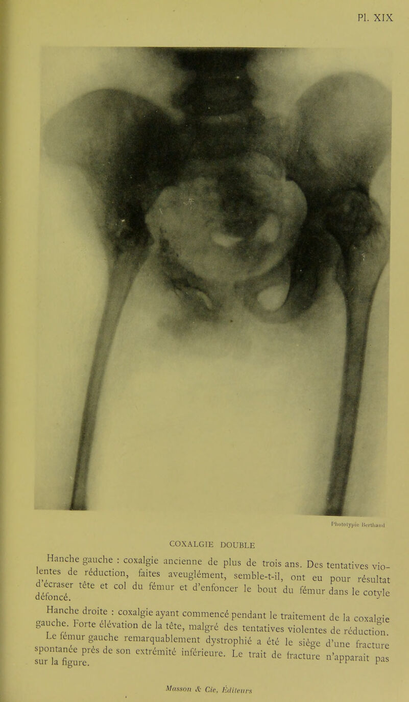 I'li(Jl(ily|)i(; lieilhauil COXALGIE DOUBLE Hanche gauche : coxalgie ancienne de plus de trois ans. Des tentatives vio- lentes de réduction, faites aveuglément, semble-t-il, ont eu pour résultat détré' '''' ^^^ 1^ Hanche droite : coxalgie ayant commencé pendant le traitement de la coxalgie gauche. Forte élévation de la tête, malgré des tentatives violentes de réduction Le temur gauche remarquablement dystrophié a été le siège d'une fncture spomanée^résdeson extrémité inl^rieure. Le trait de fract^e n'ap;::rp::