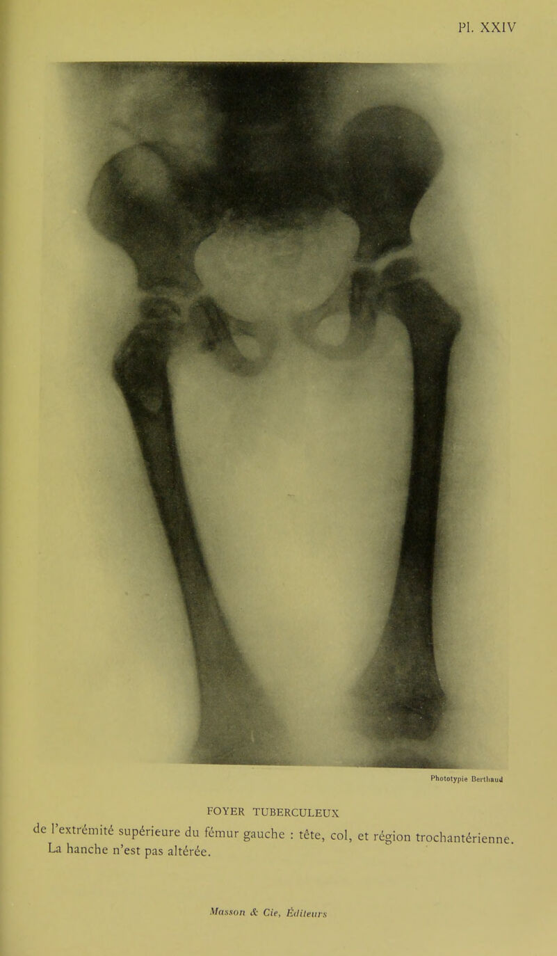 Pholotypie Beiihaud FOYER TUBERCULEUX de l'extrémité supérieure du fémur gauche : tête, col, et région trochantérienne. La hanche n'est pas altérée.