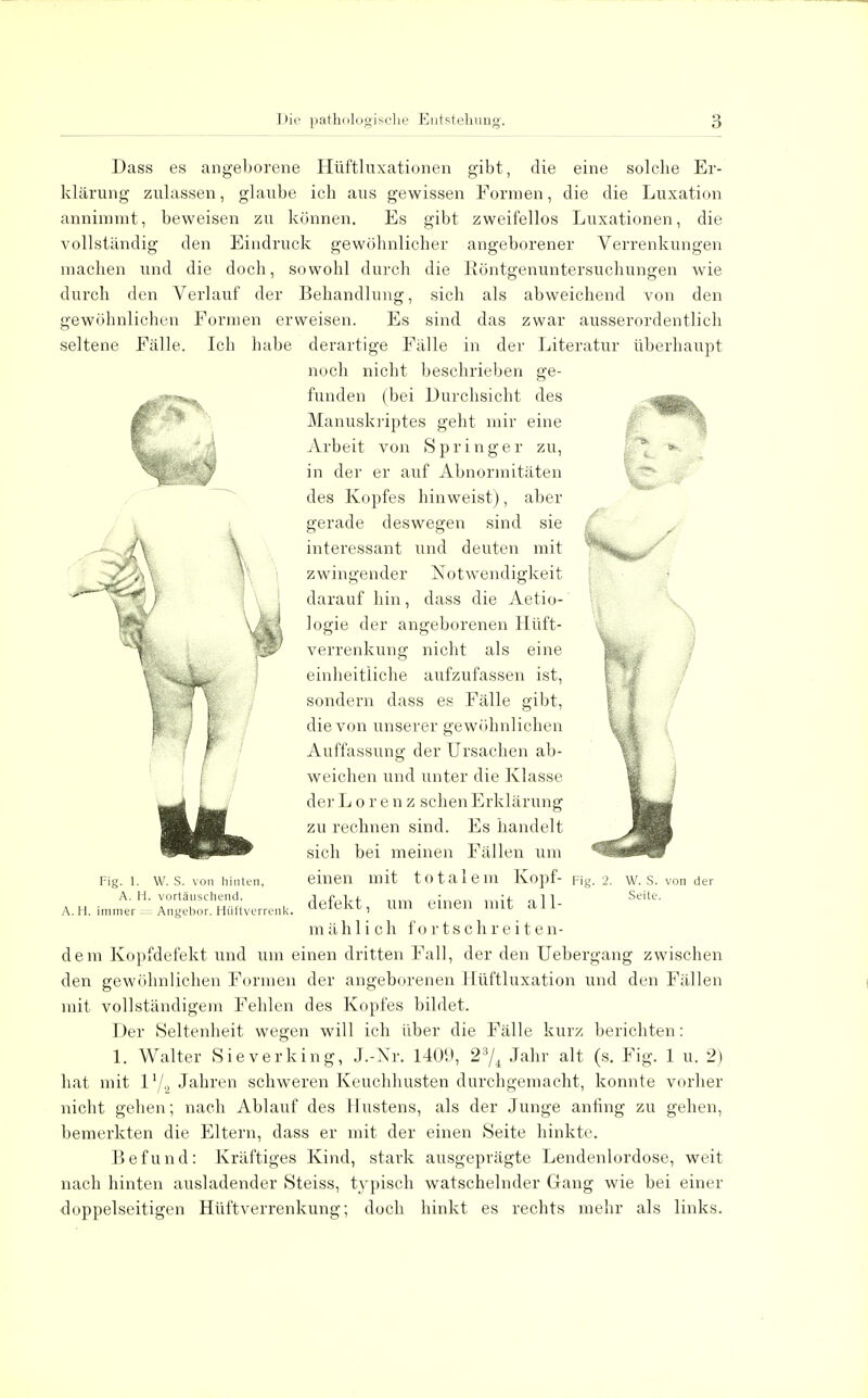 Dass es angeborene Hiiftluxationen gibt, die eine solche Er- klärung zulassen, glaube icb aus gewissen Formen, die die Luxation annimmt, beweisen zu können. Es gibt zweifellos Luxationen, die vollständig den Eindruck gewöhnlicher angeborener Verrenkungen machen und die doch, sowohl durch die Röntgenuntersuchungen wie durch den Verlauf der Behandlung, sich als abweichend von den gewöhnlichen Formen erweisen. Es sind das zwar ausserordentlich seltene Fälle. Ich habe derartige Fälle in der Literatur überhaupt noch nicht beschrieben ge- funden (bei Durchsicht des Manuskriptes geht mir eine Arbeit von Springer zu, in der er auf Abnormitäten des Kopfes hinweist), aber gerade deswegen sind sie interessant und deuten mit zwingender Notwendigkeit darauf hin, dass die Aetio- logie der angeborenen Hüft- verrenkung nicht als eine einheitliche aufzufassen ist, sondern dass es Fälle gibt, die von unserer gewöhnlichen Auffassung der Ursachen ab- weichen und unter die Klasse der Lorenz sehen Erklärung zu rechnen sind. Es handelt sich bei meinen Fällen um einen mit totalem Kopf- Fig. 2. defekt, um einen mit all- mählich f 0 r t s c h r e i t e n- dem Kopfdefekt und um einen dritten Fall, der den Uebergang zwischen den gewöhnlichen Formen der angeborenen Hüftluxation und den Fällen mit vollständigem Fehlen des Kopfes bildet. Der Seltenheit wegen will ich über die Fälle kurz berichten: 1. Walter Sieverking, J.-Xr. 1409, 23/4 Jahr alt (s. Fig. 1 u. 2) hat mit V/2 Jahren schweren Keuchhusten durchgemacht, konnte vorher nicht gehen; nach Ablauf des Hustens, als der Junge anfing zu gehen, bemerkten die Eltern, dass er mit der einen Seite hinkte. Befund: Kräftiges Kind, stark ausgeprägte Lendenlordose, weit nach hinten ausladender Steiss, typisch watschelnder Gang wie bei einer doppelseitigen Hüftverrenkung; doch hinkt es rechts mehr als links. Fig. 1. W. S. von hinten, A. Fi. vortäuschend. A. Fi. immer = Angebor. Hüftverrenk. W. S. von der Seite.
