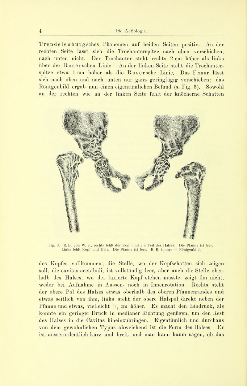 Trendelenburgsches Phänomen auf beiden Seiten positiv. An der rechten Seite lässt sich die Trochanterspitze nach oben verschieben, nach unten nicht. Der Trochanter steht rechts 2 cm höher als links über der Roserschen Linie. An der linken Seite steht die Trochanter- spitze etwa 1 cm höher als die Roser sehe Linie. Das Femur lässt sich nach oben und nach unten nur ganz geringfügig verschieben; das Röntgenbild ergab nun einen eigentümlichen Befund (s. Fig. 3). Sowohl an der rechten wie an der linken Seite fehlt der knöcherne Schatten Fig. 3. R. B. von W. S., rechts fehlt der Kopf und ein Teil des Halses. Die Pfanne ist leer. Links fehlt Kopf und Hals. Die Pfanne ist leer. R. B. immer = Röntgenbild. des Kopfes vollkommen; die Stelle, wo der Kopfschatten sich zeigen soll, die cavitas acetabuli, ist vollständig leer, aber auch die Stelle ober- halb des Halses, wo der luxierte Kopf stehen müsste, zeigt ihn nicht, weder bei Aufnahme in Aussen- noch in Innenrotation. Rechts steht der obere Pol des Halses etwas oberhalb des oberen Pfannenrandes und etwas seitlich von ihm, links steht der obere Halspol direkt neben der Pfanne und etwas, vielleicht 1/2 cm höher. Es macht den Eindruck, als könnte ein geringer Druck in medianer Richtung genügen, um den Rest des Halses in die Cavitas hineinzubringen. Eigentümlich und durchaus von dem gewöhnlichen Typus abweichend ist die Form des Halses. Er ist ausserordentlich kurz und breit, und man kann kaum sagen, ob das