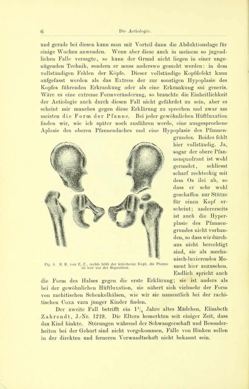 und gerade bei diesen kann man mit Vorteil dann die Abduktionslage für einige Wochen anwenden. Wenn aber diese auch in meinem so jugend- lichen Falle versagte, so kann der Grund nicht liegen in einer unge- nügenden Technik, sondern er muss anderswo gesucht werden: in dem vollständigen Fehlen der Köpfe. Dieser vollständige Kopfdefekt kann aufgefasst werden als das Extrem der zur sonstigen Hypoplasie des Kopfes führenden Erkrankung oder als eine Erkrankung sui generis. Wäre es eine extreme Formveränderung, so brauchte die Einheitlichkeit der Aetiologie auch durch diesen Fall nicht gefährdet zu sein, aber es scheint mir manches gegen diese Erklärung zu sprechen und zwar am meisten die Form der Pfanne. Bei jeder gewöhnlichen Hüftluxation rinden wir, wie ich später noch ausführen werde, eine ausgesprochene Aplasie des oberen Pfannendaches und eine Hypoplasie des Pfannen- grundes. Beides fehlt hier vollständig. Ja, sogar der obere Pfan- nenquadrant ist wohl gerundet, schliesst scharf rechteckig mit dem Os ilei ab, so dass er sehr wohl geschaffen zur Stütze Fig. 4. für einen Kopf er- scheint; andererseits ist auch die Hyper- plasie des Pfannen- grundes nicht vorhan- den, so dass wir durch- aus nicht berechtigt sind, sie als mecha- nisch-luxierendes Mo- ment hier anzusehen. Endlich spricht auch die Form des Halses gegen die erste Erklärung; sie ist anders als bei der gewöhnlichen Hüftluxation, sie nähert sich vielmehr der Form von rachitischen Schenkelhälsen, wie wir sie namentlich bei der rachi- tischen Coxa vara junger Kinder finden. Der zweite Fall betrifft ein l3/4 Jahre altes Mädchen, Elisabeth Zahrendt, J.-Nr. 1219. Die Eltern bemerkten seit einiger Zeit, dass das Kind hinkte. Störungen während der Schwangerschaft und Besonder- heiten bei der Geburt sind nicht vorgekommen, Fälle von Hinken sollen in der direkten und ferneren Verwandtschaft nicht bekannt sein. R. B. von E. Z., rechts fehlt der knöcherne Kopf, die Pfanne ist leer vor der Reposition.