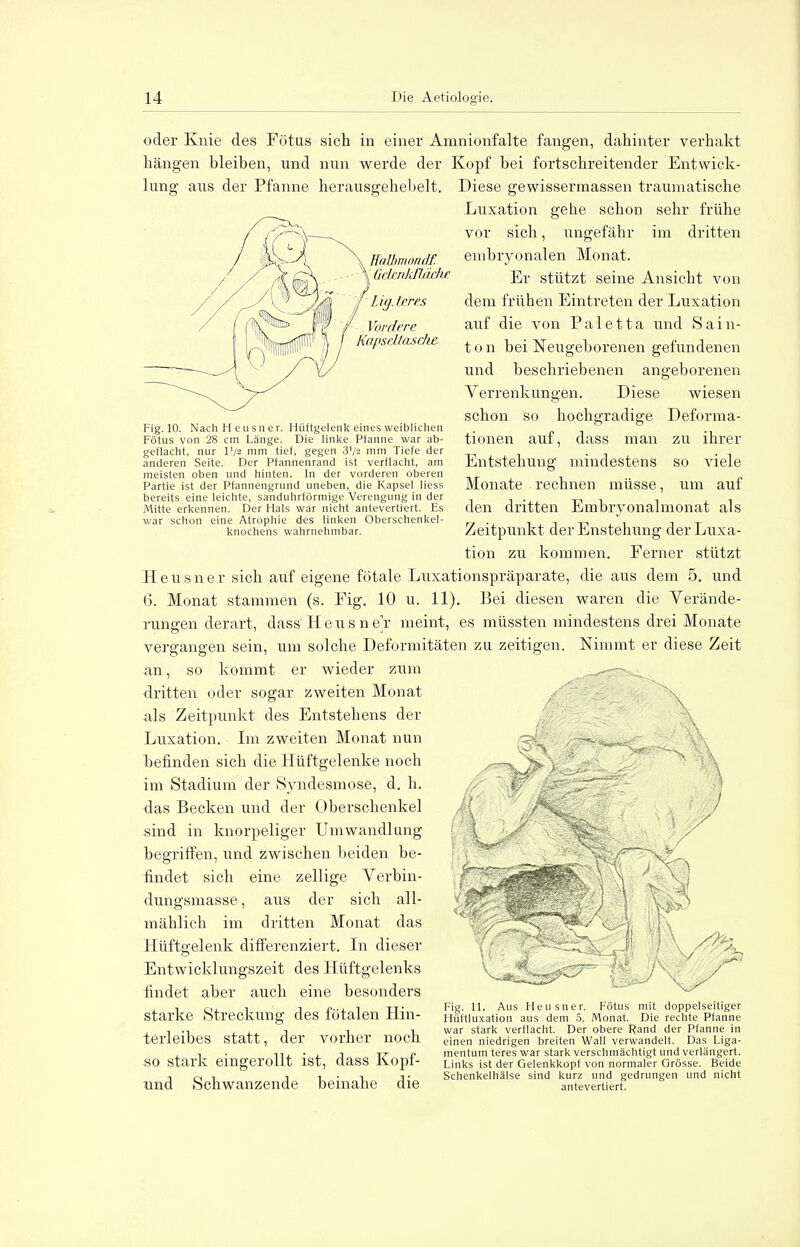 Kalbmöndf. GdmkfLäche Li (j. Irres 1 'ordere Kapseltaschz Fig. 10. Nach Heusner. Hüftgelenk eines weiblichen Fötus von 28 cm Länge. Die linke Pfanne war ab- geflacht, nur tum tief, gegen 3'/2 mm Tiefe der anderen Seite. Der Pfannenrand ist verflacht, am meisten oben und hinten. In der vorderen oberen Partie ist der Pfannengrund uneben, die Kapsel Hess bereits eine leichte, sanduhrförmige Verengung in der Mitte erkennen. Der Hals war nicht antevertiert. Es war schon eine Atrophie des linken Oberschenkel- knochens wahrnehmbar. oder Knie des Fötus sich in einer Amnionfalte fangen, dahinter verhakt hängen bleiben, und nun werde der Kopf bei fortschreitender Entwick- lung aus der Pfanne herausgehebelt. Diese gewissermassen traumatische Luxation gehe schon sehr frühe vor sich, ungefähr im dritten embryonalen Monat. Er stützt seine Ansicht von dem frühen Eintreten der Luxation auf die von Paletta nnd Sain- ton bei Neugeborenen gefundenen und beschriebenen angeborenen Verrenkungen. Diese wiesen schon so hochgradige Deforma- tionen anf, dass man zu ihrer Entstehung mindestens so viele Monate rechnen müsse, um auf den dritten Embryonalmonat als Zeitpunkt derEnstehung der Luxa- tion zu kommen. Ferner stützt Heusner sich auf eigene fötale Luxationspräparate, die aus dem 5. und 6. Monat stammen (s. Fig. 10 u. 11). Bei diesen waren die Verände- rungen derart, dass Heusner meint, es müssten mindestens drei Monate vergangen sein, um solche Deformitäten zu zeitigen. Nimmt er diese Zeit an, so kommt er wieder zum dritten oder sogar zweiten Monat als Zeitpunkt des Entstehens der Luxation. Im zweiten Monat nun befinden sich die Hüftgelenke noch im Stadium der Syndesmose, d. h. das Becken und der Oberschenkel sind in knorpeliger Umwandlung begriffen, und zwischen beiden be- findet sich eine zellige Verbin- dungsmasse, aus der sich all- mählich im dritten Monat das Hüftgelenk differenziert. In dieser Entwicklungszeit des Hüftgelenks findet aber auch eine besonders starke Streckung des fötalen Hin- terleibes statt, der vorher noch so stark eingerollt ist, dass Kopf- lind Schwanzende beinahe die f/r Fig. 11. Aus Heusner. Fötus mit doppelseitiger Hüftluxation aus dem 5. Monat. Die rechte Pfanne war stark verflacht. Der obere Rand der Pfanne in einen niedrigen breiten Wall verwandelt. Das Liga- mentum teres war stark verschmächtigt und verlängert. Links ist der Gelenkkopf von normaler Grösse. Beide Schenkelhälse sind kurz und gedrungen und nicht antevertiert.