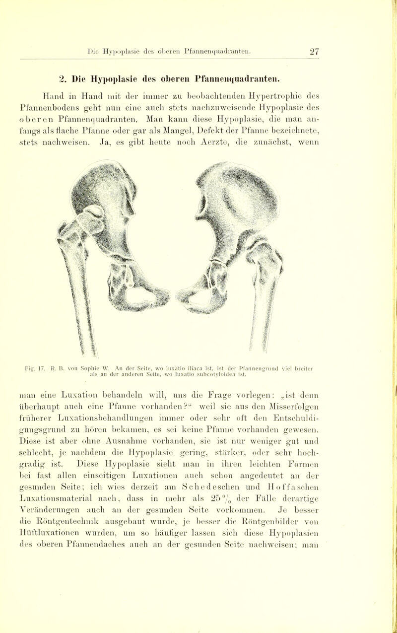 2. Die Hypoplasie des oberen Pfannenquadranten. Hand in Hand mit der immer zu beobachtenden Hypertrophie des Pfannenbodens geht nun eine auch stets nachzuweisende Hypoplasie des oberen Pfannenquadranten. Man kann diese Hypoplasie, die man an- fangs als flache Pfanne oder gar als Mangel, Defekt der Pfanne bezeichnete, stets nachweisen. Ja, es gibt heute noch Aerzte, die zunächst, wenn Fig. 17. R. B. von Sophie W. An der Seite, wo lnxatio iliaca ist, ist der Pfannengrund viel breiter als an der anderen Seite, wo luxatio subcotyloidea ist. man eine Luxation behandeln will, uns die Frage vorlegen: „ist denn überhaupt auch eine Pfanne vorhanden? weil sie aus den Misserfolgen früherer Luxationsbehandlungen immer oder sehr oft den Entschuldi- gungsgrund zu hören bekamen, es sei keine Pfanne vorhanden gewesen. Diese ist aber ohne Ausnahme vorhanden, sie ist nur weniger gut und schlecht, je nachdem die Hypoplasie gering, stärker, oder sehr hoch- gradig ist. Diese Hypoplasie sieht man in ihren leichten Formen bei fast allen einseitigen Luxationen auch schon angedeutet an der gesunden Seite; ich wies derzeit am Sched eschen und Hoffaschen Luxationsmaterial nach, dass in mehr als 25°/0 der Fälle derartige Veränderungen auch an der gesunden Seite vorkommen. Je besser die Röntgentechnik ausgebaut wurde, je besser die Röntgenbilder von Hüi'tluxationen wurden, um so häufiger lassen sich diese Hypoplasien des oberen Pfannendaches auch an der gesunden Seite nachweisen; man
