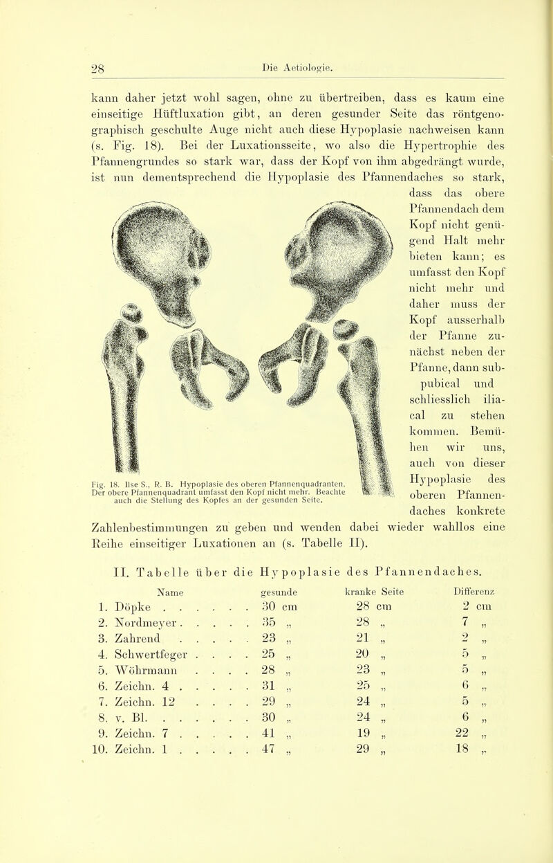 kann daher jetzt wohl sagen, ohne zu übertreiben, dass es kaum eine einseitige Hüftluxation gibt, an deren gesunder Seite das röntgeno- graphisch geschulte Auge nicht auch diese Hypoplasie nachweisen kann (s. Fig. 18). Bei der Luxationsseite, wo also die Hypertrophie des Pfannengrundes so stark war, dass der Kopf von ihm abgedrängt wurde, ist nun dementsprechend die Hypoplasie des Pfannendaches so stark, dass das obere Pfannendach dem Kopf nicht genü- gend Halt mehr bieten kann; es umfasst den Kopf nicht mehr und daher muss der Kopf ausserhalb der Pfanne zu- nächst neben der Pfanne, dann sub- pubical und schliesslich ilia- cal zu stehen kommen. Bemü- hen wir uns, auch von dieser Hypoplasie des oberen Pfannen- daches konkrete Zahlenbestimniungen zu geben und wenden dabei wieder wahllos eine Reihe einseitiger Luxationen an (s. Tabelle II). II. Tabelle über die Hypoplasie des Pfannend aches. Name gesunde kranke Seite Differenz L Döpke . . .... 30 cm 28 cm 2 cm 2. Nordmeyer. .... 35 i? 28 11 7 „ 3. Zahrend . ... 23 ii 21 11 2 4. Schwertfeger . ... 25 1> 20 11 5 „ 5. Wöhrmann . ... 28 11 23 1! 5 „ 6. Zeichn. 4 . . ... 31 11 25 11 6 „ 7. Zeichn. 12 .... 29 11 24 11 5 ii 8. v. Bl. . . . ... 30 11 24 11 6 ,i 9. Zeichn. 7 . . ... 41 11 19 11 22 „ 10. Zeichn. 1 . . ... 47 11 29 11 18 ,.