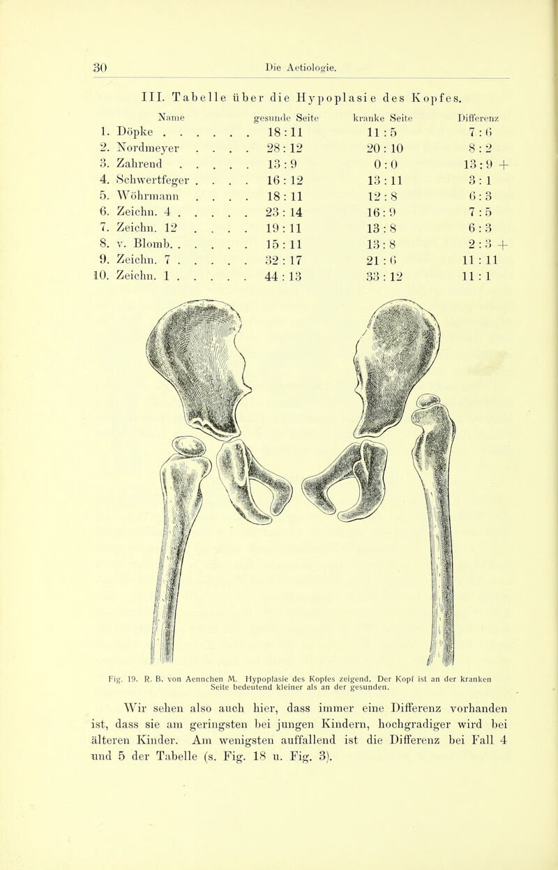 III. Tabelle über die Hypoplasie des Kopfes. Name gesunde Seite kranke Seite Differenz 1. Döpke 18 :11 11:5 7:6 2. Nordmeyer .... 28: 12 20: 10 8:2 3. Zahrend 13 : 9 0:0 13:9 + 4. Schwertfeger . ... 16: 12 13:11 3:1 5. Wöhrmann ....18:11 12:8 6:3 6. Zeichn. 4 23 : 14 16:9 7:5 7. Zeichn. 12 .... 19: 11 13:8 6:3 8. v. Blomb 15: 11 13:8 2:3 + 9. Zeichn. 7 32 : 17 21 : 6 11 : 11 10. Zeichn. 1 44 : 13 33 : 12 11:1 Fig. 19. R. B. von Aennchen M. Hypoplasie des Kopfes zeigend. Der Kopf ist an der kranken Seite bedeutend kleiner als an der gesunden. Wir sehen also auch hier, dass immer eine Differenz vorhanden ist, dass sie am geringsten bei jungen Kindern, hochgradiger wird bei älteren Kinder. Am wenigsten auffallend ist die Differenz bei Fall 4 und 5 der Tabelle (s. Fig. 18 u. Fig. 3).