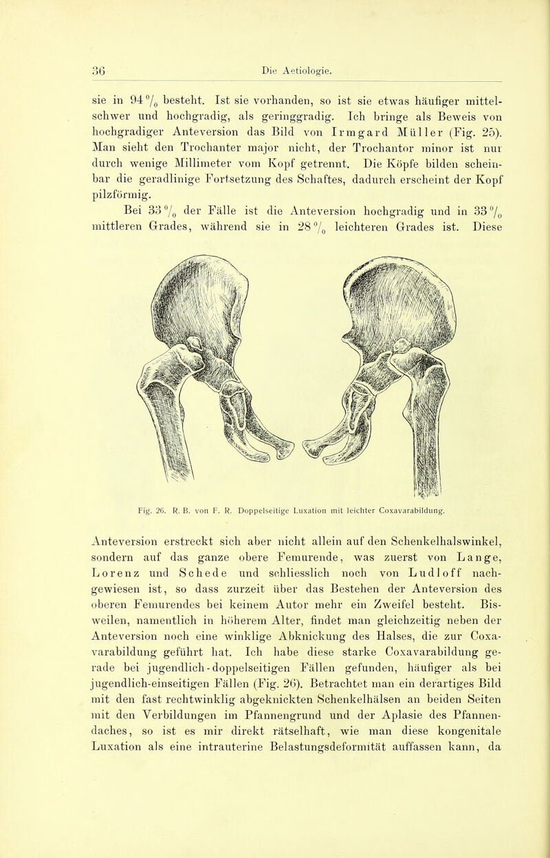sie in 94°/0 besteht. Ist sie vorhanden, so ist sie etwas häufiger mittel- schwer und hochgradig, als geringgradig. Ich bringe als Beweis von hochgradiger Anteversion das Bild von Irmgard Müller (Fig. 25). Man sieht den Trochanter major nicht, der Trochantor minor ist nur durch wenige Millimeter vom Kopf getrennt. Die Köpfe bilden schein- bar die geradlinige Fortsetzung des Schaftes, dadurch erscheint der Kopf pilzförmig. Bei 33 °/o der Fälle ist die Anteversion hochgradig und in 33 % mittleren Grades, während sie in 28% leichteren Grades ist. Diese Fig. 26. R. B. von F. R. Doppelseitige Luxation mit leichter Coxavarabildung. Anteversion erstreckt sich aber nicht allein auf den Schenkelhalswinkel, sondern auf das ganze obere Femurende, was zuerst von Lange, Lorenz und Schede und schliesslich noch von Ludloff nach- gewiesen ist, so dass zurzeit über das Bestehen der Anteversion des oberen Femurendes bei keinem Autor mehr ein Zweifel besteht. Bis- weilen, namentlich in höherem Alter, findet man gleichzeitig neben der Anteversion noch eine winklige Abknickung des Halses, die zur Coxa- varabildung geführt hat. Ich habe diese starke Coxavarabildung ge- rade bei jugendlich-doppelseitigen Fällen gefunden, häufiger als bei jugendlich-einseitigen Fällen (Fig. 26). Betrachtet man ein derartiges Bild mit den fast rechtwinklig abgeknickten Schenkelhälsen an beiden Seiten mit den Verbildungen im Pfannengrund und der Aplasie des Pfannen- daches, so ist es mir direkt rätselhaft, wie man diese kongenitale Luxation als eine intrauterine Belastungsdeformität auffassen kann, da