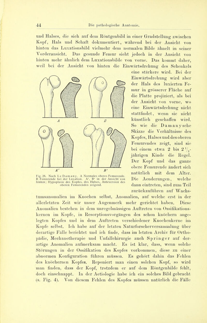und Halses, die sich, auf dem Röntgenbild in einer Gradstellung zwischen Kopf, Hals und Schaft dokumentiert, wahrend bei der Ansicht von hinten das Luxationsbild vielmehr dem normalen Bilde ähnelt in seiner Vorderansicht. Das gesunde Femur sieht jedoch in der Ansicht von hinten mehr ähnlich dem Luxationsbilde von vorne. Das kommt daher, weil bei der Ansicht von hinten die Einwärtsdrehung des Schenkels eine stärkere wird. Bei der Einwärtsdrehung wird aber der Hals des luxierten Fe- mur in grösserer Fläche auf die Platte projiziert, als bei der Ansicht von vorne, wo eine Einwärtsdrehung nicht stattfindet, wenn sie nicht künstlich geschaffen wird. So wie die Damanysche Skizze die Verhältnisse des Kopfes, Halses und des oberen Femurendes zeigt, sind sie bei einem etwa 2 bis 2 j ährigen Kinde die Regel. Der Kopf und das ganze obere Femurende ändert sich natürlich mit dem Alter. Die Aenderungen, welche dann eintreten, sind zum Teil zurückzuführen auf Wachs- tumsanomalien im Knochen selbst, Anomalien, auf welche erst in der allerletzten Zeit wir unser Augenmerk mehr gerichtet haben. Diese Anomalien bestehen in dem unregelmässigen Auftreten von Ossifikations- kernen im Kopfe, in Resorptionsvorgängen des schon knöchern ange- legten Kopfes und in dem Auftreten verschiedener Knochenkerne im Kopfe selbst. Ich habe auf der letzten Naturforseherversammlung über derartige Fälle berichtet und ich finde, dass im letzten Archiv für Ortho- pädie, Mechanotherapie und Unfallchirurgie auch Springer auf der- artige Anomalien aufmerksam macht. Es ist klar, dass, wenn solche Störungen in der Ossifikation des Kopfes vorkommen, diese zu einer abnormen Konfiguration führen müssen. Es gehört dahin das Fehlen des knöchernen Kopfes. Reponiert man einen solchen Kopf, so wird man finden, dass der Kopf, trotzdem er auf dem Röntgenbilde fehlt, doch einschnappt. In der Aetiologie habe ich ein solches Bild gebracht (s. Fig. 4). Von diesem Fehlen des Kopfes müssen natürlich die Fälle